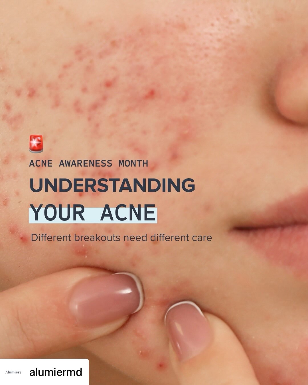 Acne Awareness Month is a reminder that clearer-looking skin starts with understanding, not guesswork. 🤍
With the right routine and consistency, balance begins to fall into place.
Swipe through to learn more. @alumiermd
#alumiermd #skincare #clinicalskincare #healthyskin