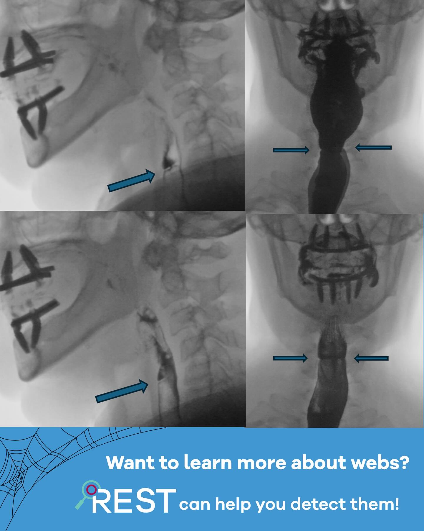 Are you familiar with extrinsic cricopharyngeal muscle dysfunction? This can occur from a scar band - or web - tethering the CP muscle which can negatively impact distension and duration (and therefore bolus passage). 🛑
EGDs miss these all the time. The REST 🔍 protocol can help you detect these and guide the endoscopist on where exactly to treat! The REST course will help you understand how they develop and interventions available.
Sign up for the next REST course now - it’ll be here before you know it! 🧠
Visit our website: www.esophagealcolab.com
Comment WEB for more details! 🕸️