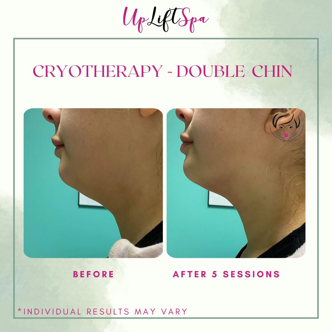 Snatched profile, no surgery ✨
Cryotherapy for the double chin helps reduce localized fat and improve definition over time — creating a more sculpted, contoured look.
This is what consistency looks like… real results after a series of sessions.
Less fullness. More definition.
📲 Ready to start your transformation? DM me “CRYO” and let’s build your plan.
#cryotherapy #doublechinreduction #snatchedjawline #medspanyc