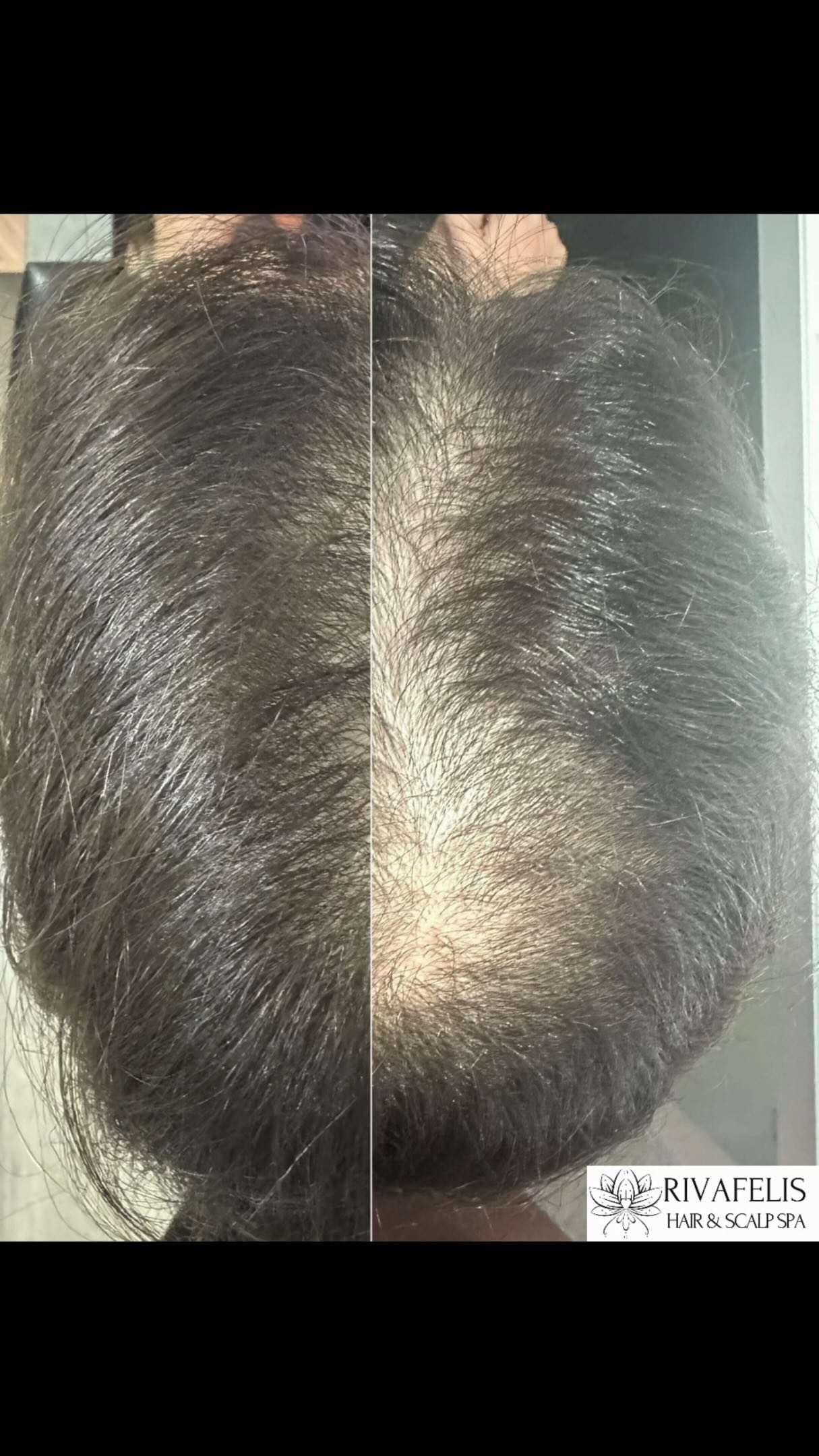 Look at this transformation.
Female, mid-20s, experiencing Female Pattern Hair Loss combined with excessive hair shedding.
Instead of focusing only on hair growth, we started by addressing the root causes. Our priority was to calm scalp inflammation, reduce hair shedding, and target the factors contributing to follicle miniaturisation.
Once the scalp environment became healthier, we focused on stimulating growth, improving follicle nutrition, and supporting stronger, thicker hair.
The result? This incredible transformation in just 5 sessions of our exclusive R.I.S.E METHOD.
If you’re struggling with hair thinning, excessive shedding, reduced density, or feel like you’ve tried everything without success, you’re not alone.
Hair loss is not something you simply have to live with.
Send us a message and let us help you understand what’s happening and create a personalised plan for your hair and scalp health.