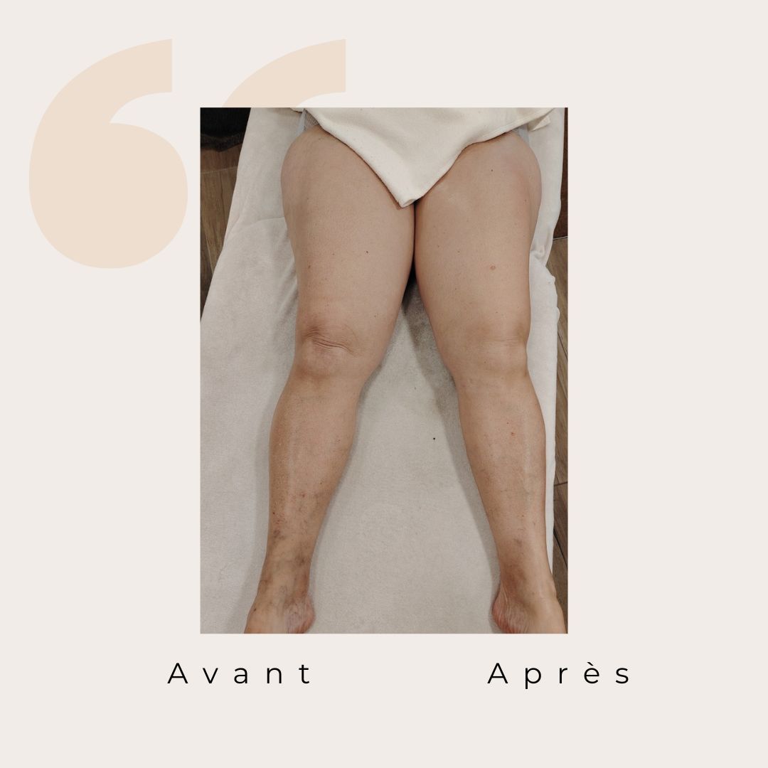 ✨ Avant / Après – Drainage lymphatique Renata França ✨
Dès la première séance, le corps réagit.
Des jambes visiblement plus légères, un galbe redessiné et une sensation immédiate de bien-être 🌿
Le drainage lymphatique Renata França agit en profondeur pour :
✨ stimuler la circulation lymphatique
✨ réduire la rétention d’eau
✨ affiner et détoxifier les jambes
✨ apporter une sensation de légèreté durable
Résultat visible, ressenti immédiat 🤍
Chaque corps est unique, les résultats peuvent varier, mais la légèreté, elle, est toujours au rendez-vous ✨
#drainagelymphatique #renatafranca #avantapres #jambeslegeres #retentiondeau #bienetre #soincorps #detox #momentpoursoi