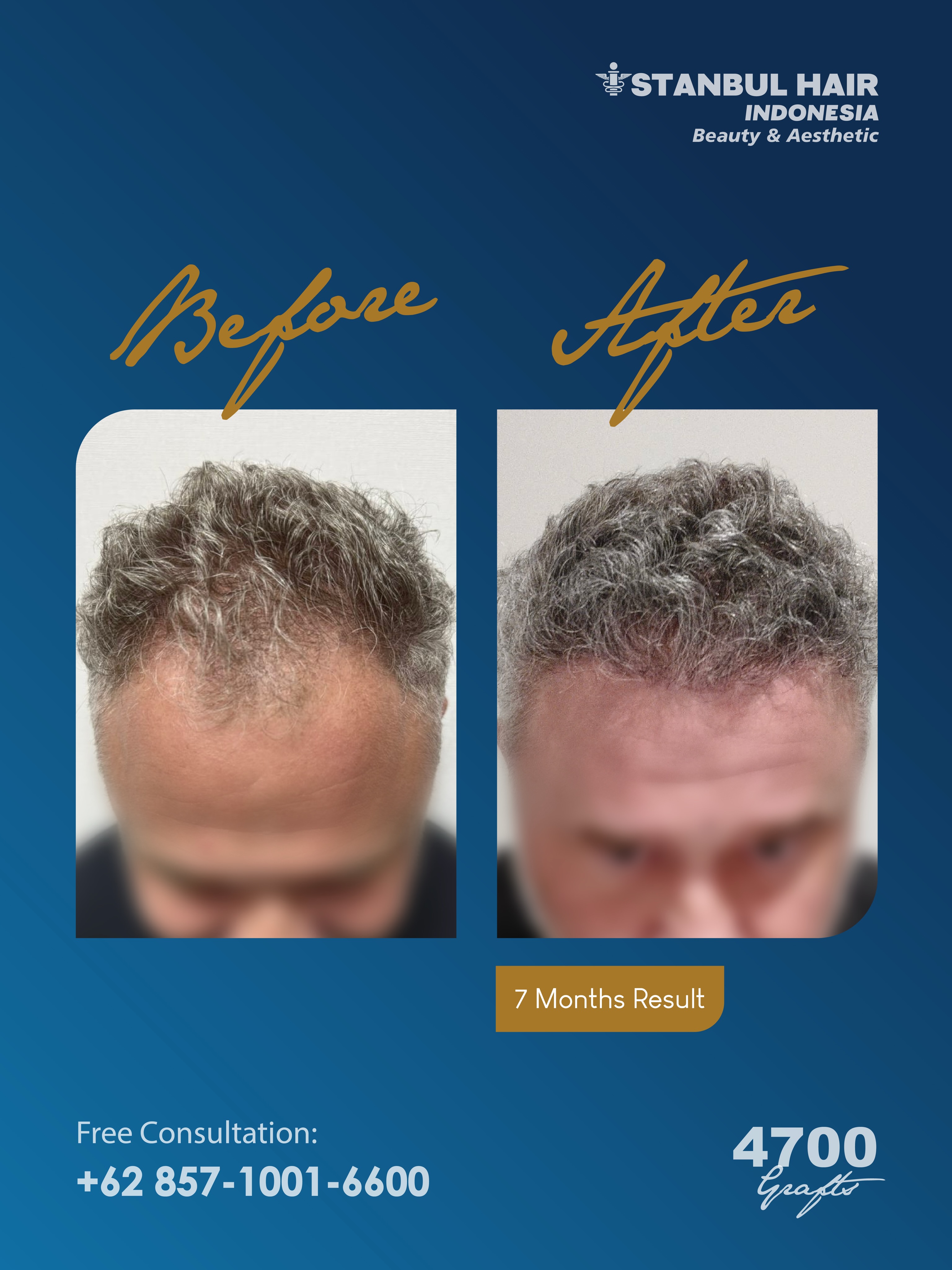Hasil 7 bulan pasca hair transplant dengan 4700 grafts ✨
Perubahan terlihat semakin maksimal dengan kepadatan yang lebih merata dan hairline yang tetap natural.
Konsultasi GRATIS tersedia untuk Anda.
—
7-month progress after a 4700 grafts hair transplant ✨
The transformation appears fuller with improved density and a natural-looking hairline.
Free consultation available.
#HairTransplant #4700Grafts #HairRestorationJourney #IstanbulHairIndonesia #HairTransplantResult
