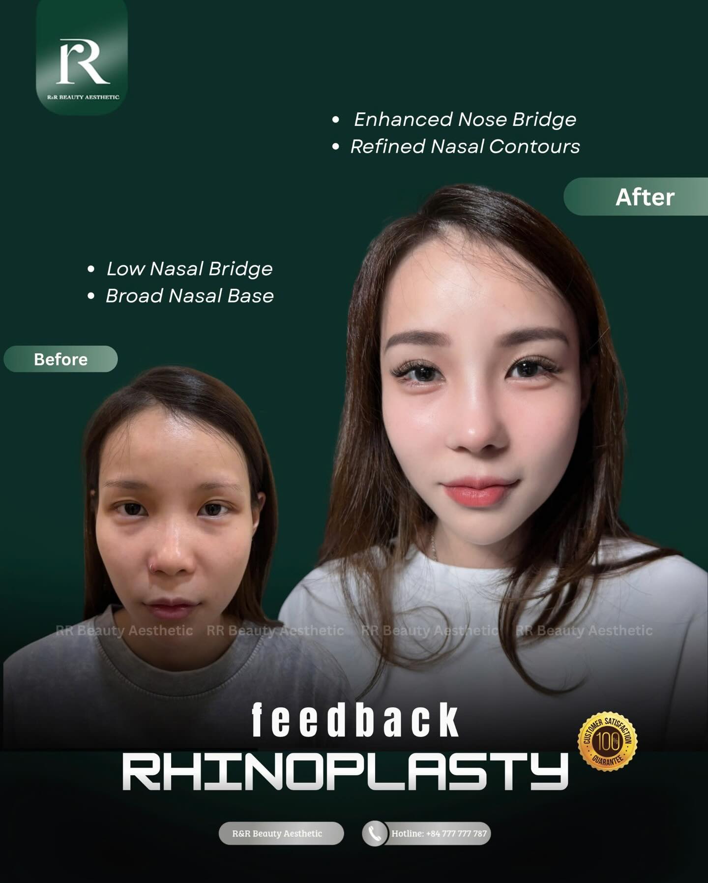 ✨ RHINOPLASTY – REFINED BEAUTY, PERFECT HARMONY ✨
A beautifully shaped nose has the power to transform the entire face.
Whether you're looking to enhance a low nose bridge, refine wide nasal wings, improve facial proportions, or achieve a more elegant profile, rhinoplasty can create natural-looking results tailored to your unique features.
✔ Enhanced nose bridge definition
✔ Refined nasal contours
✔ Improved facial harmony
✔ More elegant side profile
✔ Natural-looking proportions
✔ Personalized nose design for every face
At RR Beauty Aesthetics, every rhinoplasty procedure is carefully planned to complement your facial structure, ensuring results that are balanced, sophisticated, and uniquely yours.
✨ Refined Contours
✨ Better Facial Balance
✨ Naturally Beautiful Results
Because the most beautiful nose is not the highest one—it's the one that perfectly harmonizes with your face. 🤍
🎯 Performed by experienced plastic surgeons
🎯 International-standard surgical techniques
🎯 Personalized consultation and aftercare
📍 RR Beauty Aesthetics
📞 Hotline: +84 777 777 787
#rhinoplasty #nosejob #noseenhancement #facialharmony #rrbeautyaesthetics
rhinoplasty nose enhancement low nose bridge correction facial harmony refined nose contours side profile improvement natural beauty transformation premium aesthetic clinic