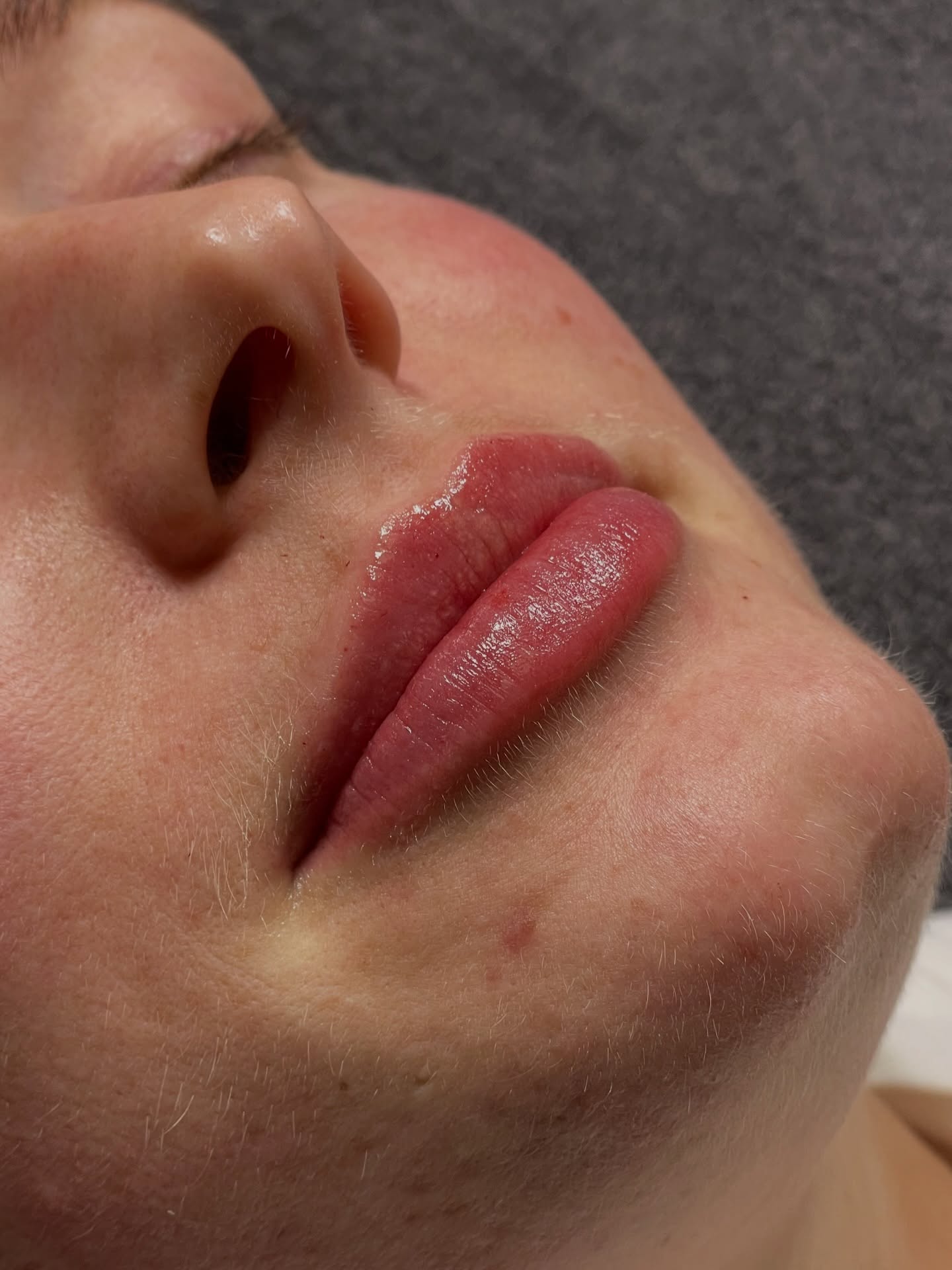 Restylane Kysse 💋 Vår favoritt leppefiller for definisjon, sirkulasjon, fukt og naturlig volum ♥️
20 års aldersgrense, grundig konsultasjon er obligatorisk og naturligvis inkludert i vår pris.