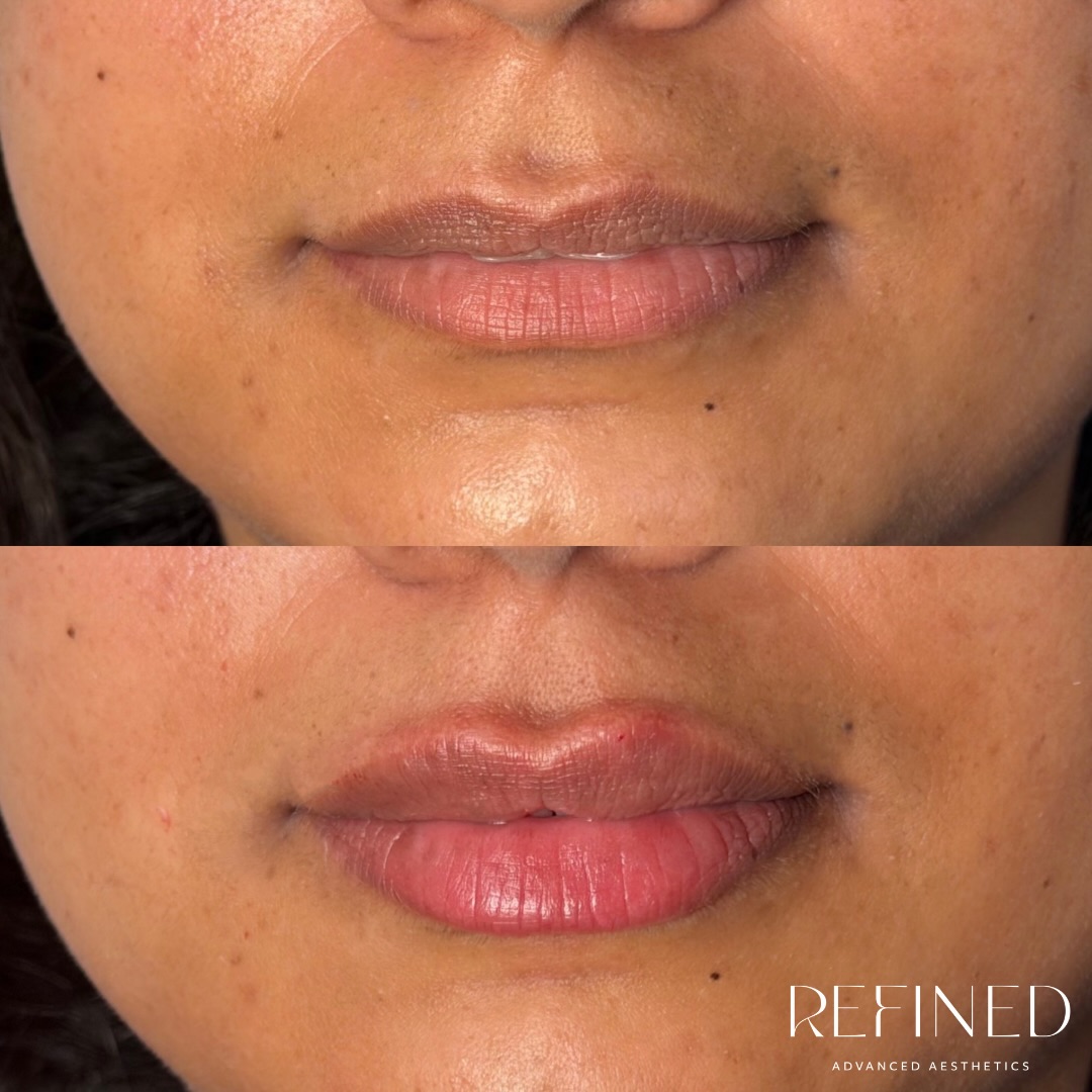 Virgin lips enhanced with 0.5ml for a soft, naturally fuller appearance ☁️
This bespoke treatment was carefully tailored to complement the client’s features, adding gentle volume, refined definition, and beautiful balance. Subtle enhancements that make all the difference ✨
Freshly treated lips 👄 Mild swelling is normal immediately after treatment and can create temporary asymmetry. Final results are visible once the swelling has settled over the following days 🫶🏼