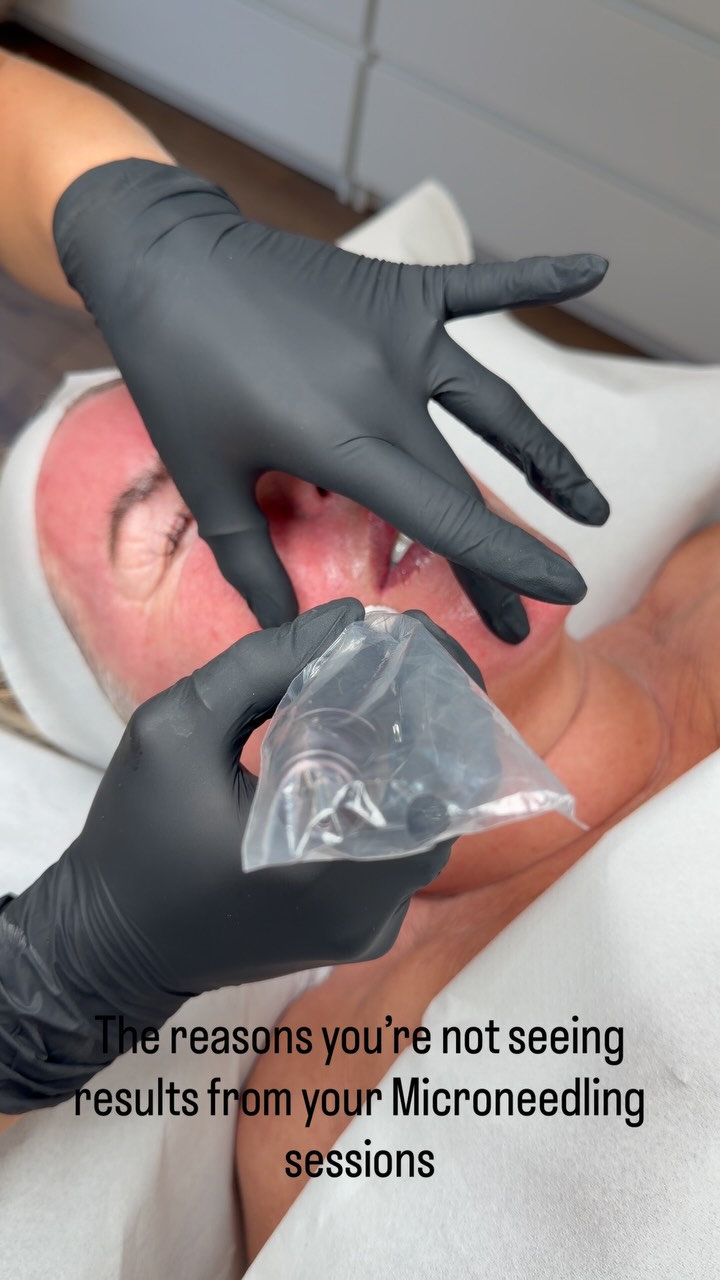 ✨ The real reason you’re not seeing results from microneedling… ✨
Spoiler 🚨 if it’s done right, then it’s not the treatment itself, it’s what happens between your appointments that makes the biggest difference, but also make sure to choose your therapist wisely.
✔️ Consistency matters. Microneedling works by stimulating collagen production over time, not overnight. Skipping sessions or leaving long gaps between treatments can slow your progress.
✔️ Your homecare routine is just as important. Using the right skincare products helps support healing, your skin barrier and collagen production.
✔️ SPF is non-negotiable. Freshly treated skin is more vulnerable to UV damage, and sun exposure can lead to pigmentation issues and compromise your results.
✔️ Avoid excessive sun exposure. Whether it’s a sunny holiday, sunbeds, or spending hours outdoors without protection, UV exposure can undo the benefits of your treatment, SPF / hats are your new best friend.
✔️ Trust the process. Skin renewal takes time. The best results come from a treatment plan, not a one-off session.
Microneedling is a journey, not a quick fix. Stay consistent, protect your skin, follow your aftercare, and you’ll give your skin the best chance to achieve those glowing, long-lasting results. ✨
Microneedling Liverpool
Results Merseyside
Collagen Induction Therapy
Skin Rejuvenation
Healthy Skin
Glowing Skin
Skincare Journey
SPF Everyday
Skin Clinic
Skin Health
Anti Ageing