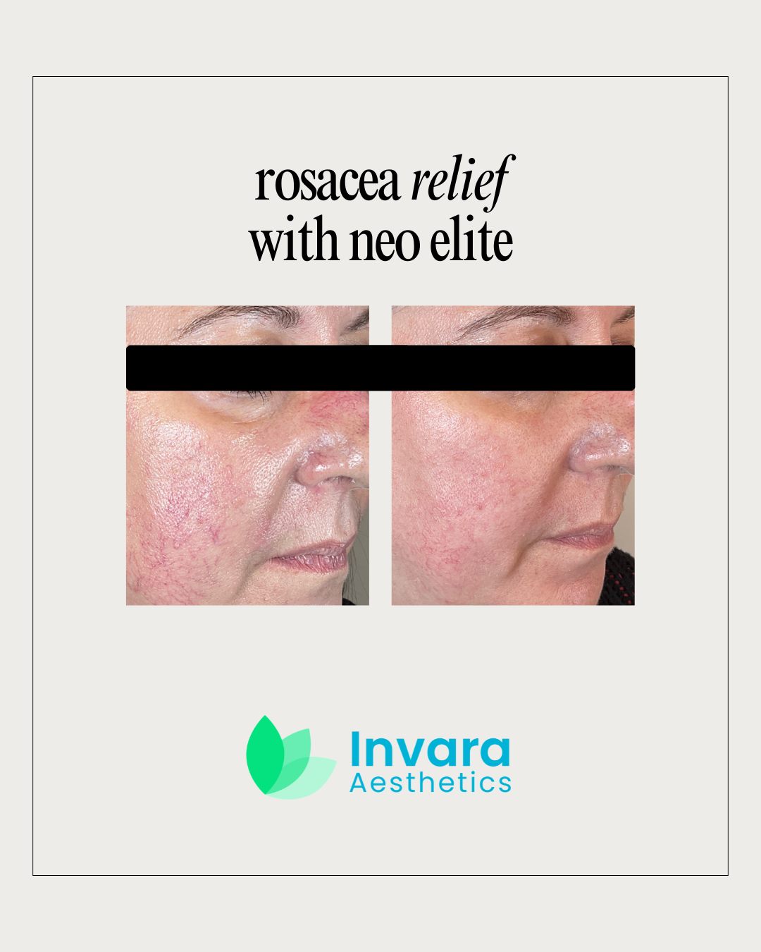 Rosacea can present itself in many different ways from persistent facial redness and flushing to visible blood vessels, sensitivity, and acne-like bumps.
Our Neo Elite laser treatment works by targeting the blood vessels that contribute to redness while stimulating healthier-looking skin with no downtime!
If you or someone you know struggles with rosacea, this treatment is perfect for you!!
Schedule your consultation today and see if Neo treatments are right for you.
🌍www.invara-aesthetics.com
📞(360) 208-8743
📍19624 US-2 Monroe WA 98272
#RosaceaRelief #SkinCareTreatment #LaserSkinCare #FacialRedness #HealthySkin #SensitiveSkinCare #SkinHealth #AestheticClinic #NeoEliteLaser