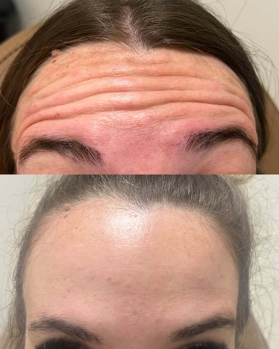 “I’ve been thinking about it for years, but I’m scared to start.”
I hear that almost every week.
This patient sat in my chair as a first-time tox patient with many of the same concerns:
• “Will I look frozen?”
• “Will people know I had something done?”
• “What if I don’t like it?”
• “Am I too young? Too old?”
The truth is, most people aren’t looking to change their face. They’re looking to soften the lines that make them look tired, angry, stressed, or older than they feel.
We created a customized treatment plan focused on her concerns while preserving natural movement and expression.
3 weeks later, she returned for her follow-up.
Her forehead lines are dramatically softened.
Her frown lines are smoother.
Her crow’s feet are reduced.
And most importantly—she still looks like herself.
No frozen forehead.
No surprised eyebrows.
No obvious signs that she had anything done.
Just refreshed, rested, and confident.
If you’ve been considering tox but keep talking yourself out of it because you’re nervous, you’re not alone. Most of my patients wish they had done it sooner after seeing how natural the results can be.
The hardest part is often scheduling the consultation.
Let’s talk about your goals, answer your questions, and create a plan that feels right for you.
📍 Villa Aesthetics
📅 Complimentary consultations available
📩 Send a message or book online to get started
Because sometimes the best results are the ones nobody can quite put their finger on—they just think you look amazing.