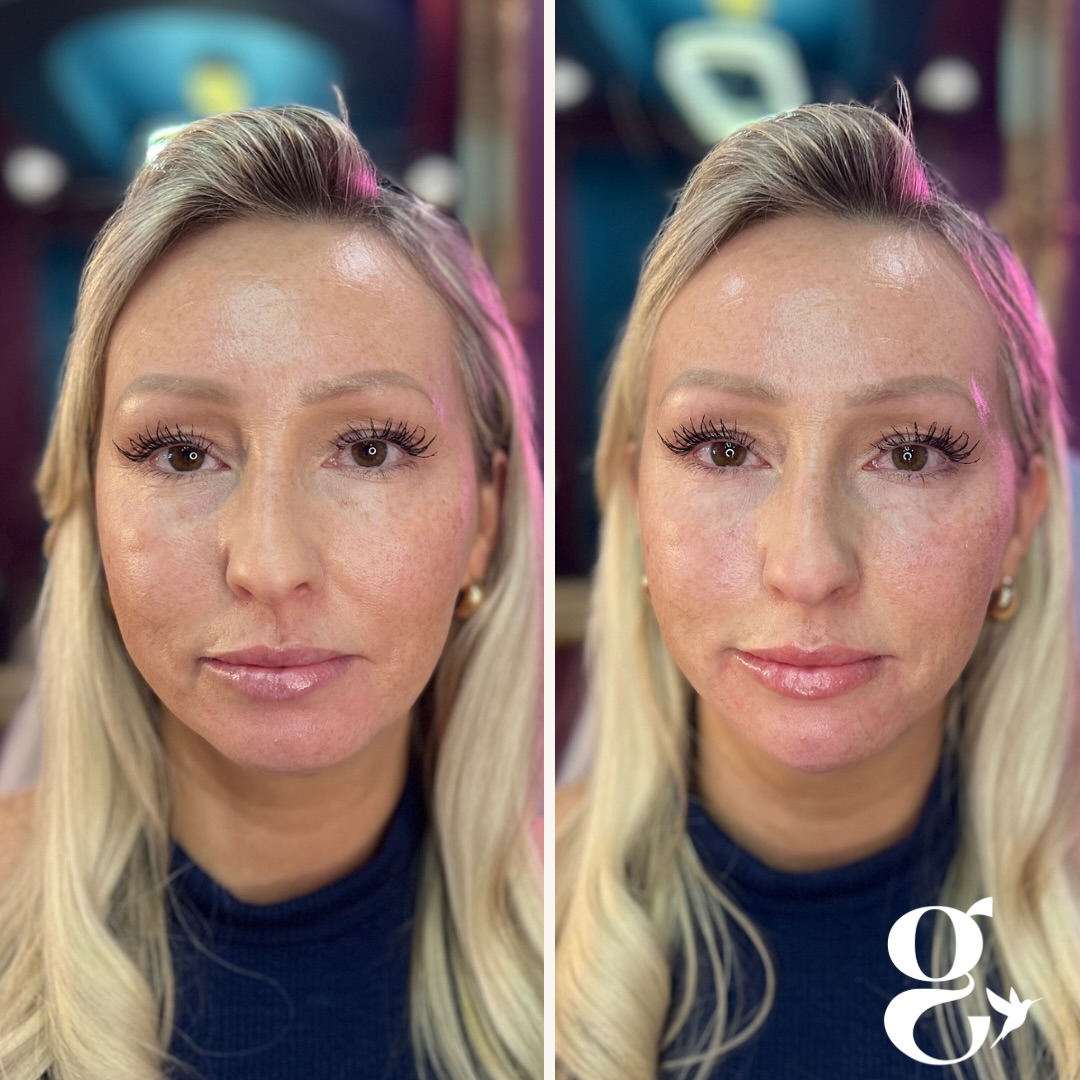 What nobody tells you about filler…
The best filler results are usually the ones nobody realizes are filler.
Most people think filler means bigger lips, overfilled cheeks, or looking “done.”
But when facial balancing is done thoughtfully, people don’t notice the filler.
They notice that you look rested.
They notice that you look refreshed.
They notice that you look amazing.
This patient received customized treatment through the cheeks, jawline, and chin/jowl area to restore balance and support where volume had naturally changed over time.
The goal was never to change her face.
The goal was to help her look like herself… just a little more refreshed.
And if you’ve been curious about filler but feel overwhelmed by the investment, our Goldie Beauty Banks were designed with you in mind. Continue your routine Botox, bank funds monthly, and work toward larger treatments over time without paying for everything at once.
Luxury skin starts with a plan.
Ready to learn what facial balancing could look like for you?
Text the office at 209-867-7101 to schedule your consultation.
✨ Natural. Balanced. Undetectable. The Goldie way.