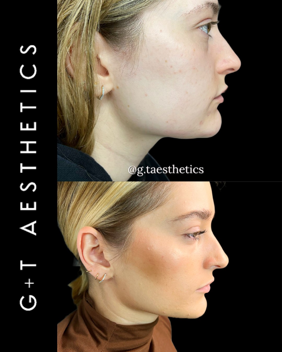 Stubborn pockets of fat can be difficult to shift through lifestyle changes alone.
Aqualyx is designed to target and break down localised fat cells, helping to create a more contoured and refined appearance in treated areas.
📲Enquire or visit www.gtaesthetics.co.uk for more info.
#Aqualyx #FatDissolving #BodyContouring #BeforeAndAfter #AestheticClinic #StamfordAesthetics #GTAesthetics
