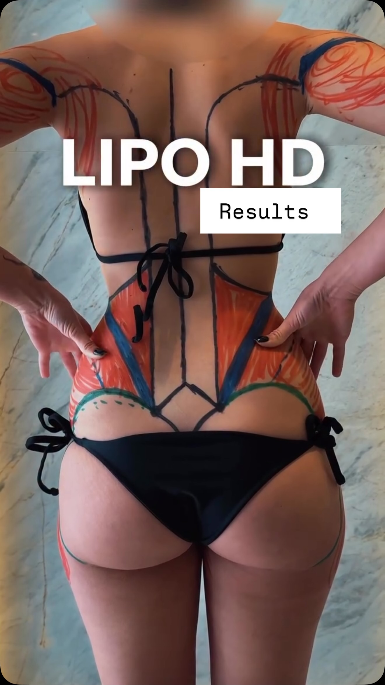 Full combo lipos for our customer.
Feedback affer 3 months #medicaltourism #lipo #liposucción #lipo360