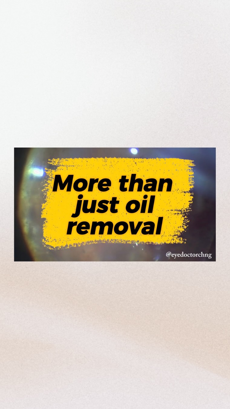Sometimes there is more than just silicone oil to remove from a vitrectomy surgery …
#vitreoretinalsurgery #lensfragment #eyesurgery #ophthalmology #eyedoctorchng