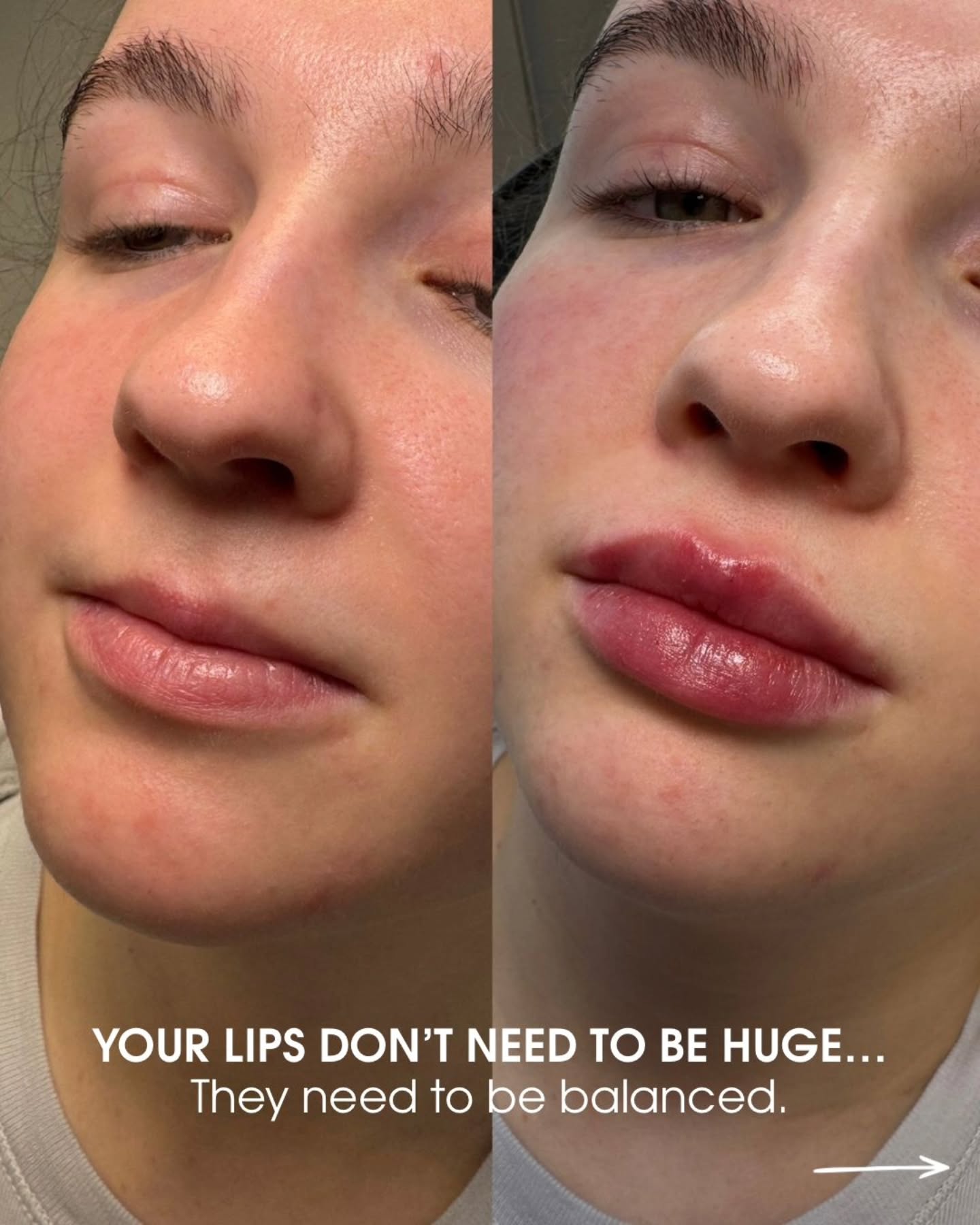 ✨🤍 SUBTLE. BALANCED. BEAUTIFULLY YOU. 🤍✨
Lip filler isn’t about making lips bigger—it’s about enhancing what’s already there. Thoughtful placement, natural proportions, and results tailored to your unique features create the kind of transformation that looks effortless.
A little definition. A little hydration. A lot of confidence.
✨ Personalised treatment plans
✨ Natural-looking enhancement
✨ Balanced, harmonious results
DM “LIPS” to book your consultation or learn more.
#lipfillerswarrington #naturallipfiller #lipenhancement #balancedbeauty #aestheticswarrington