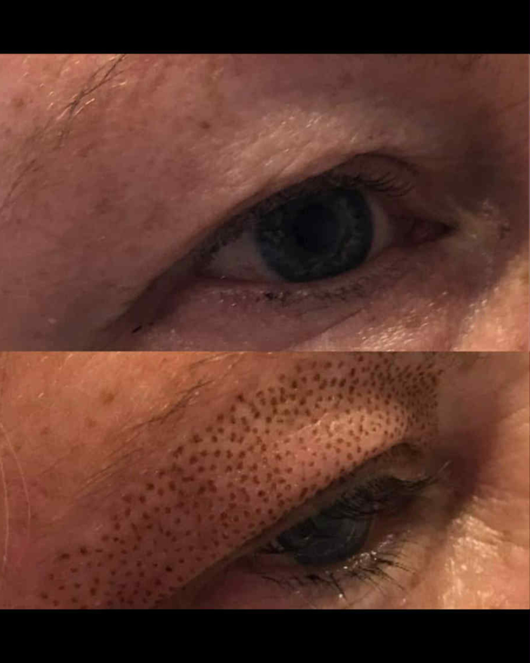 โจ PLASMA PEN โ EYE AREA RESULTS โจ
Smoother, tighter-looking skin around the eyes with visible improvement over time ๐
A non-surgical option designed to refresh and rejuvenate this delicate area.
๐ Utopia Beauty & Aesthetics, Menai Bridge
๐ DM to book your consultation