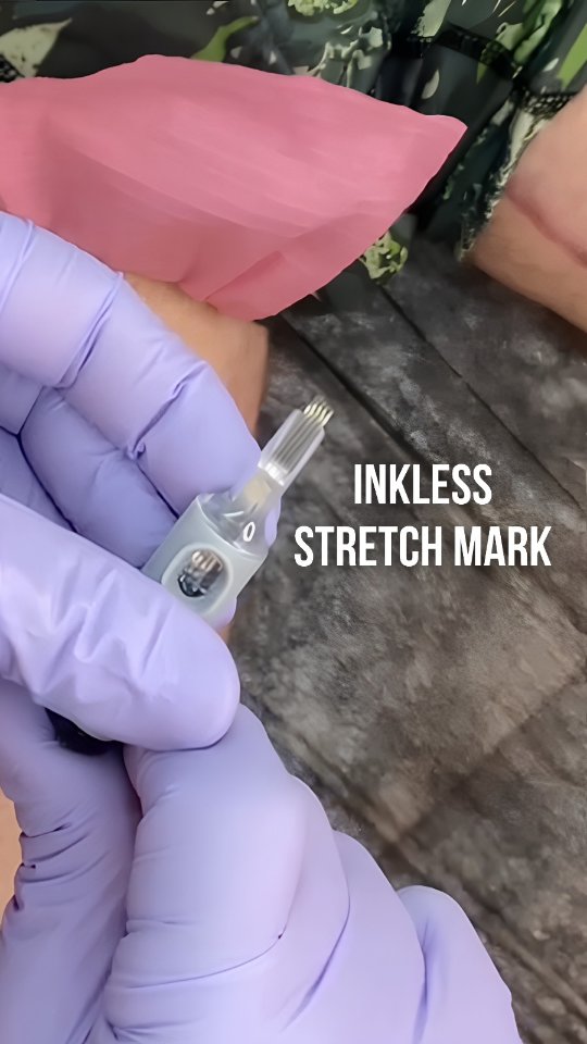 I bet you see that big beautiful scar, we’re waiting for it to mature so in the meantime we’re working on some stretch marks surround the scar until it’s ready.
Stay tuned for more. For private consultation link in bio!
#Bodyloveink #surgicalscars #ifixscars #thighlift #StretchMarks