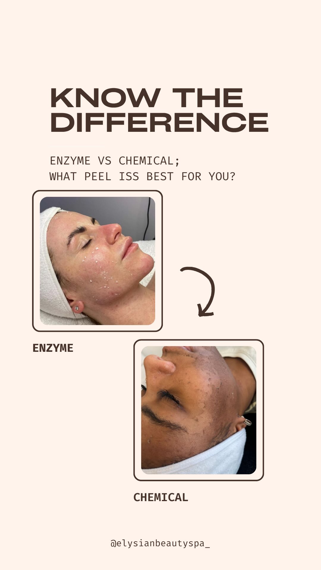 Enzyme Peel vs Chemical Peel: What’s the Difference? 🤔✨
Not all peels work the same way!
🍍 Enzyme Peels use natural fruit enzymes to gently dissolve dead skin cells sitting on the surface of the skin. They’re perfect for sensitive skin, first-time peel clients, and anyone wanting a brighter, smoother complexion with little to no downtime.
🧪 Chemical Peels use active acids (such as lactic, glycolic, or salicylic acid) to exfoliate deeper within the skin. They can help target concerns like pigmentation, acne, congestion, fine lines, and uneven skin texture while stimulating skin renewal.
Enzyme Peel Benefits:
✨ Gentle exfoliation
✨ Instantly brighter skin
✨ Smooth, refreshed complexion
✨ Suitable for sensitive skin
Chemical Peel Benefits:
✨ Improves pigmentation and sun damage
✨ Helps manage acne and congestion
✨ Softens fine lines
✨ Improves overall skin texture and tone
The best peel for you depends on your skin type, concerns, and goals. During your consultation, we’ll recommend the most suitable treatment for your skin journey. 💛
📍Ready to discover which peel is right for you? Send us a DM or book your skin consultation today.
#ChemicalPeel #EnzymePeel #SkinEducation #HealthySkin #GlowingSkin
