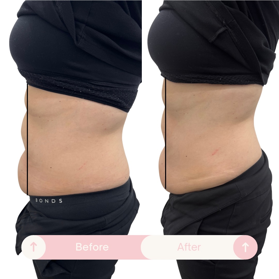 9cm gone after just ONE 40-minute treatment 🔥
No surgery.
No downtime.
No recovery.
This client lost an incredible 9cm in a single session, creating a visibly smoother and more contoured waistline.
✨ Usually $120
✨ This week only $99
If you’ve been struggling with stubborn areas that won’t budge despite your best efforts, this could be exactly what you’ve been looking for!
Limited appointments available this week and next.
Comment “🔥” below or send us a DM to secure your $99 special before it’s gone.