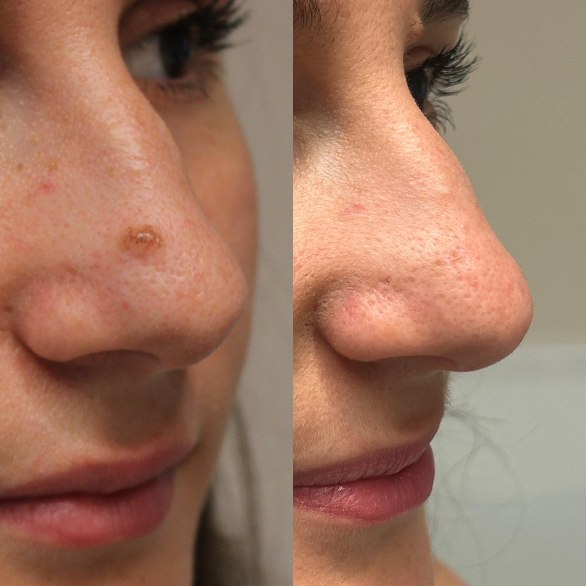 Asportazione di neo del naso eseguita con tecnologia laser: trattamento rapido, preciso e minimamente invasivo, senza necessità di punti di sutura e con un risultato estetico eccellente.
Vedere la serenità e la soddisfazione dei miei pazienti dopo il trattamento è sempre la parte più gratificante del mio lavoro. ❤️
La dermatologia moderna ci permette di ottenere risultati sempre più efficaci, rispettando al massimo la pelle e riducendo il rischio di cicatrici visibili.
#chirurgialaser