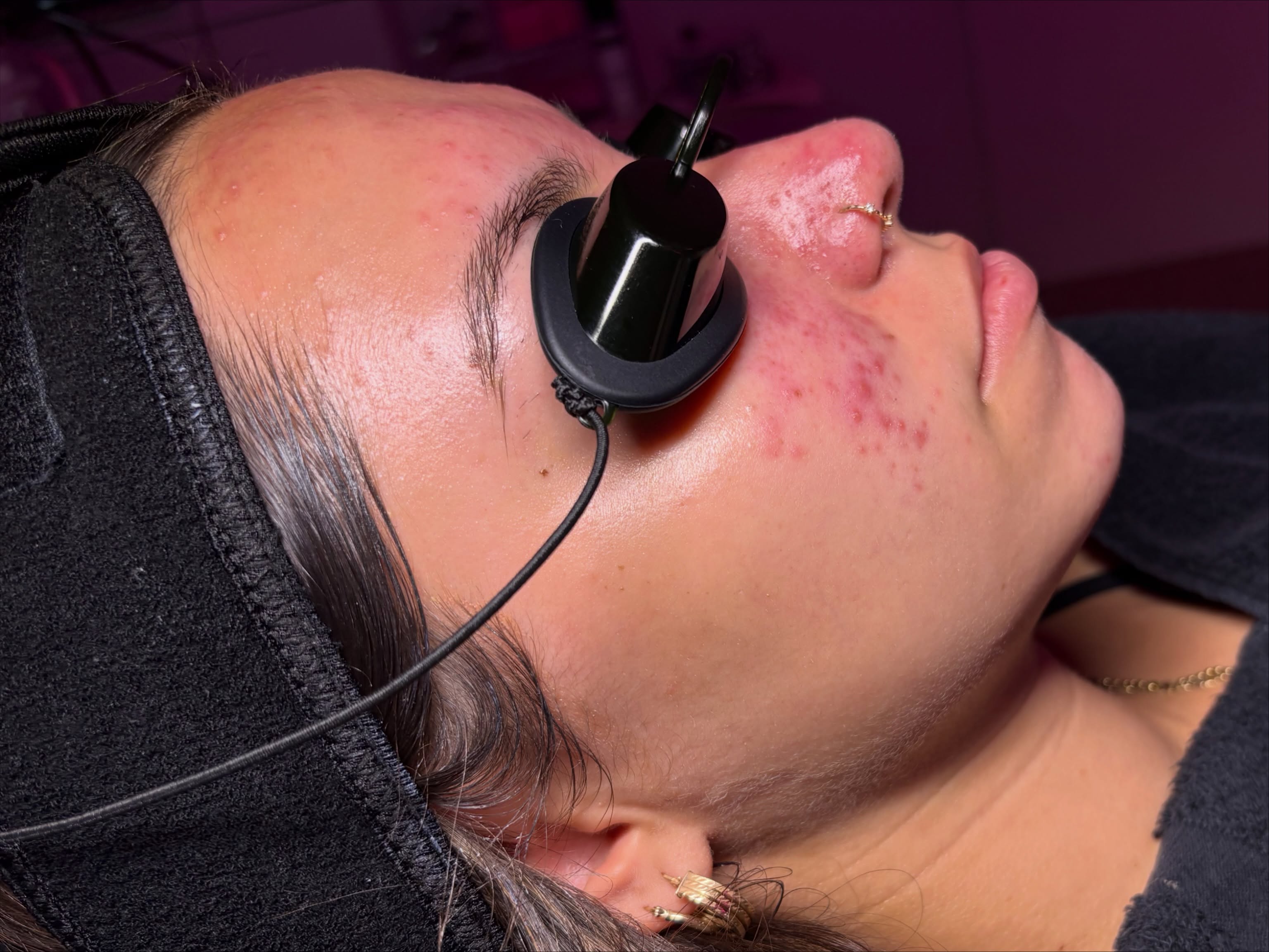Swipe right ❤️
My client has Type 2 Rosacea, an acne imposter! 🧐
At Phoenix Skin Sanctuary, we prioritize healing the barrier and the nervous system, by taking the time to listen and give the skin/soul what it needs.
Every skin type, nervous system, and life is different.
Not every story fits into a protocol. ❤️
#phoenixesthetician#azskincare#phoenixskin#azacne#barrierrepair