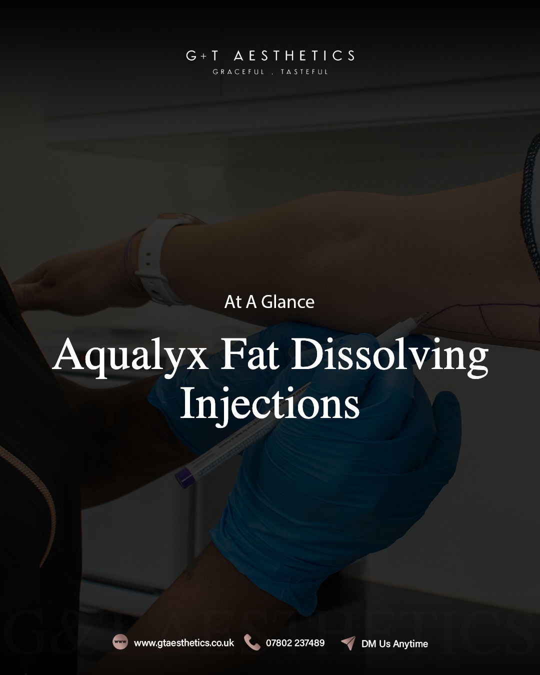 A targeted injectable treatment for reducing localised fat deposits.
Discomfort: Mild
Session time: 30-60 minutes
Longevity: Permanent
Results develop gradually as the body naturally processes the treated fat cells.
📲Enquire or visit www.gtaesthetics.co.uk for more info.
#Aqualyx #FatDissolvingTreatment #BodyContour #AestheticClinic #StamfordClinic #GTAesthetics
