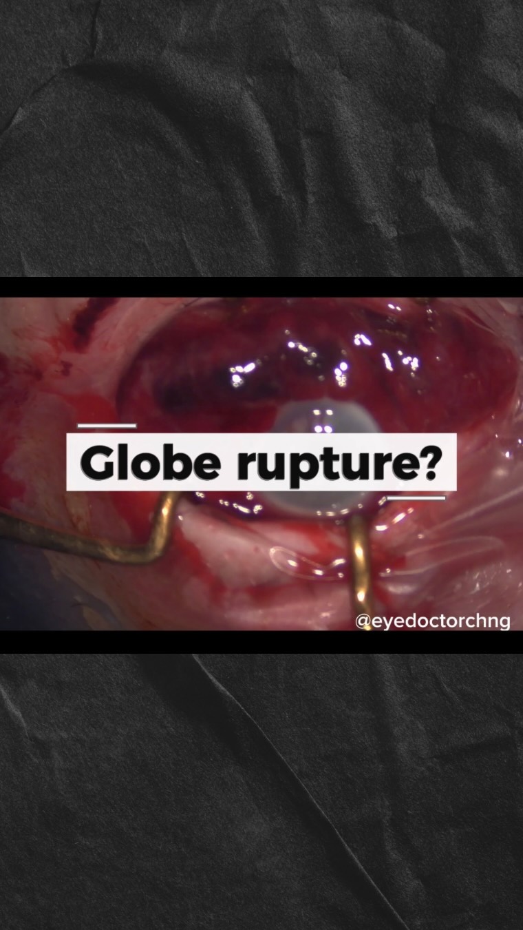 Remember to search thoroughly in the eye during a suspected globe rupture repair surgery.
Also remember one of the most common site of scleral rupture is posterior to the rectus muscle where the sclera is the thinnest.
Amazing and tidy surgery by our senior VR fellow at BMEC @veleyesaris Well done!!
#globerupture #eyesurgery #ophthalmology #eyetrauma #eyedoctorchng