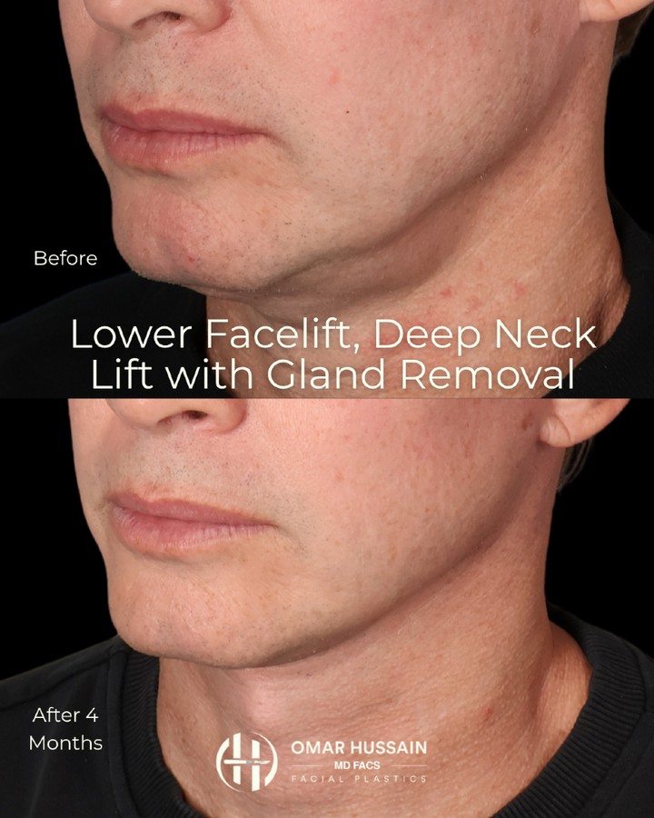 A sharper jawline. A stronger profile. A naturally refreshed appearance. ✨
This male patient underwent a Lower Facelift and Deep Neck Lift with gland reduction to restore definition and create a cleaner neck-to-jawline transition. The result is a more youthful, structured look that remains masculine and completely natural.
The goal isn't to change the face—it's to restore the strength and definition that time gradually takes away.
#facialrejuvenation #deepnecklift #facelift #facialplasticsurgery #beverlyhillsplasticsurgeon