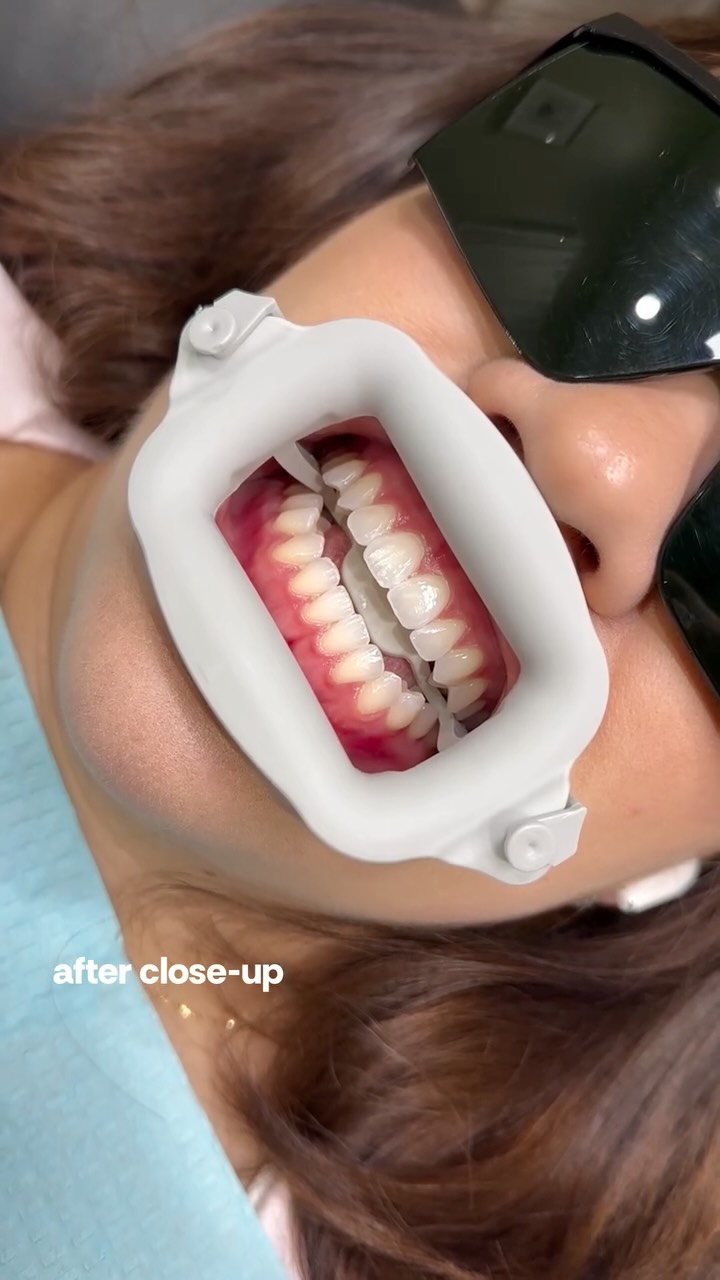 Freshly brightened & still natural ✨
the kind of glow that just fits your smile perfectly.
#teethwhitening #napervilleteethwhitening #napervilleil #chicagoteethwhitening #luxthesmile