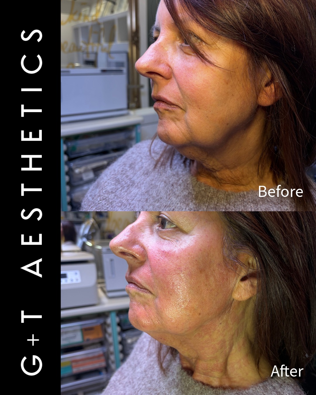 Improved firmness and skin quality through targeted collagen stimulation. RF skin tightening works beneath the surface to help improve laxity, smooth texture and enhance overall skin tone.
📲Enquire or visit www.gtaesthetics.co.uk for more info.
#RFSkinTightening #SkinFirming #BeforeAndAfter #CollagenBoost #AestheticClinic #GTAesthetics