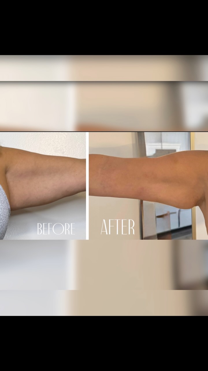 🚨 Deja de esconder tus brazos. 💪✨
Este es el tipo de resultado que te hará volver a usar tops sin pensarlo dos veces.
✨ Menos flacidez
✨ Más firmeza
✨ Más definición
✨ Más confianza
Con Levage Endolaser, tecnología dual hacemos lipolisis y lifting en un solo procedimiento además contamos con control de temperatura avanzada para mayor precisión y seguridad. 🌡️💙
Porque no se trata de cambiar quién eres, sino de ayudarte a sentirte mejor en tu propia piel.
📩📩 Escríbenos para agendar tu evaluación y descubrir si el Endoláser en brazos es para ti.
#Endolaser #ArmLift #SkinTightening #BodyContouring #AestheticMedicine