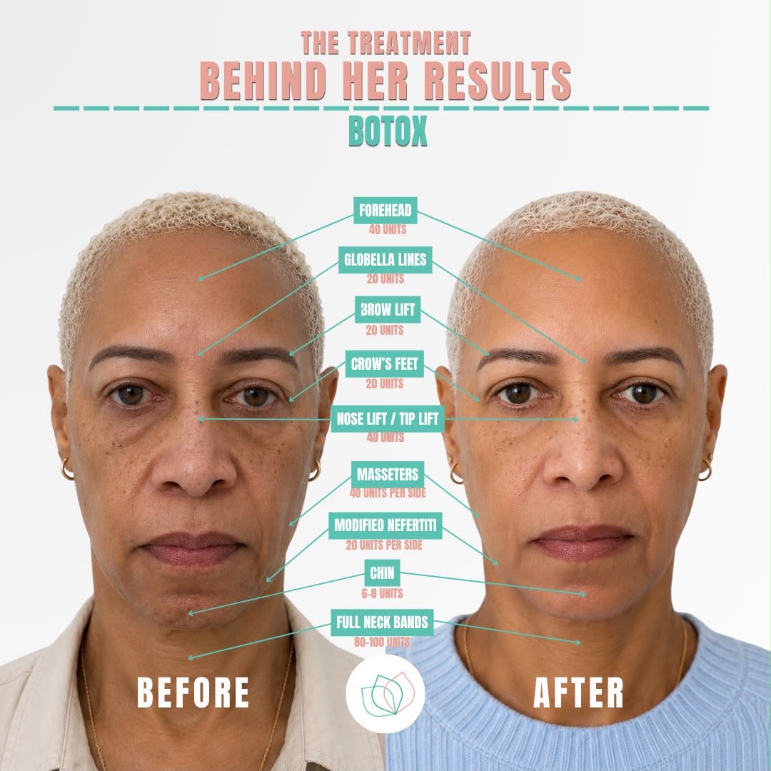 Ever wonder what actually goes into achieving that flawless, snatched, and refreshed look?
It’s not about changing your face it’s about strategically placing the right units to enhance your natural beauty.
Click the link in our bio to book your consultation today!
📍4600 West Village Place 3005, Smyrna, Georgia
#prettyfacesatlanta #atlbotox #selfcareatl #glowup #atlantaaesthetics