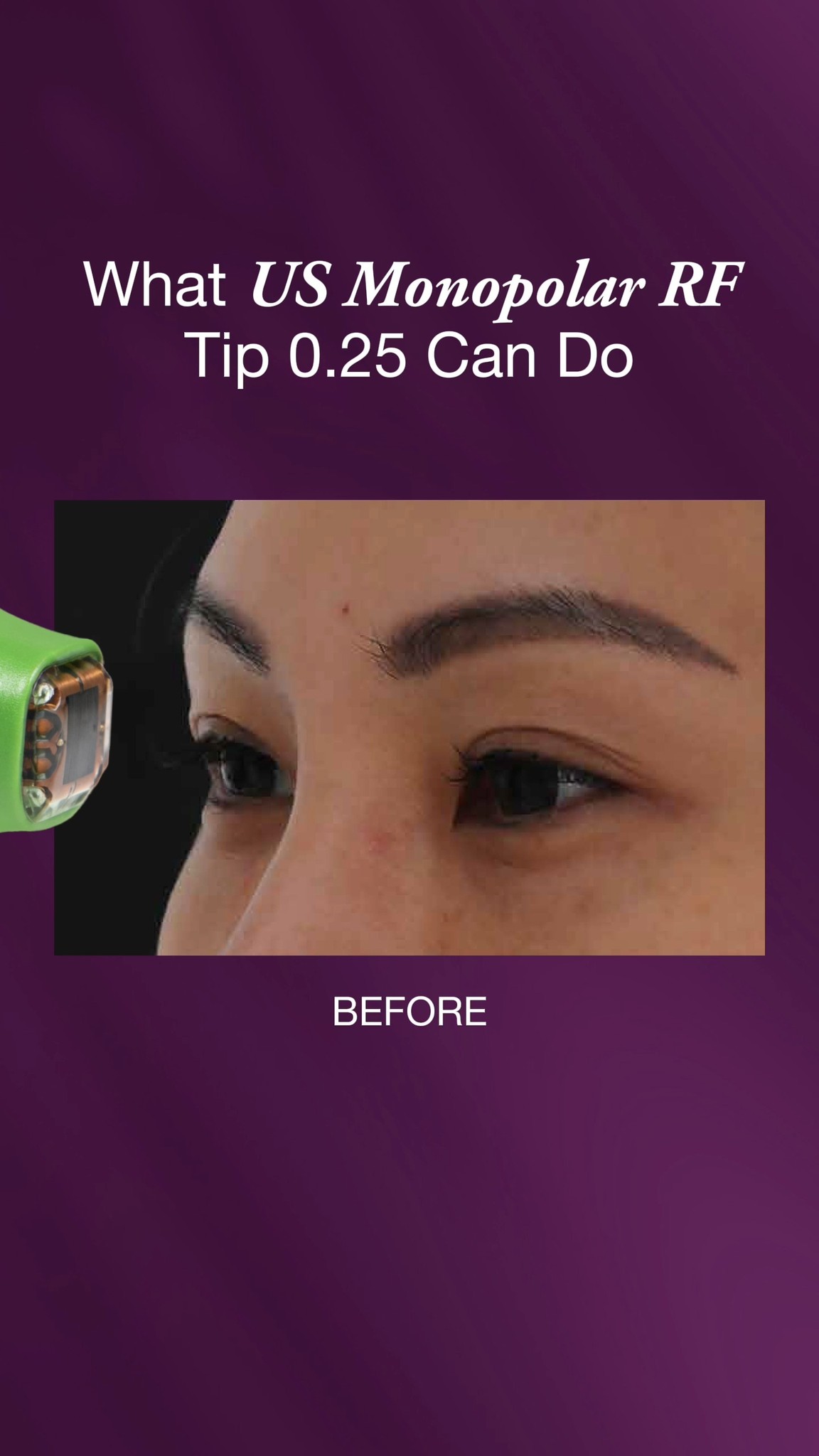 What can you expect with Thermage's Eye Treatment?
Watch to find out.
Choose the Original US Monopolar Radiofrequency technology. Approved by FDA for Upper Eyelids.
THFLX.0034.SG.26
𝘛𝘩𝘦𝘳𝘮𝘢𝘨𝘦®️ 𝘍𝘓𝘟 𝘪𝘴 𝘢 𝘳𝘦𝘨𝘪𝘴𝘵𝘦𝘳𝘦𝘥 𝘮𝘦𝘥𝘪𝘤𝘢𝘭 𝘥𝘦𝘷𝘪𝘤𝘦 𝘪𝘯𝘵𝘦𝘯𝘥𝘦𝘥 𝘧𝘰𝘳 𝘶𝘴𝘦 𝘣𝘺 𝘲𝘶𝘢𝘭𝘪𝘧𝘪𝘦𝘥 𝘩𝘦𝘢𝘭𝘵𝘩𝘤𝘢𝘳𝘦 𝘱𝘳𝘰𝘧𝘦𝘴𝘴𝘪𝘰𝘯𝘢𝘭𝘴 𝘰𝘯𝘭𝘺. 𝘛𝘩𝘪𝘴 𝘮𝘢𝘵𝘦𝘳𝘪𝘢𝘭 𝘪𝘴 𝘧𝘰𝘳 𝘪𝘯𝘧𝘰𝘳𝘮𝘢𝘵𝘪𝘰𝘯𝘢𝘭 𝘱𝘶𝘳𝘱𝘰𝘴𝘦𝘴 𝘢𝘯𝘥 𝘥𝘰𝘦𝘴 𝘯𝘰𝘵 𝘤𝘰𝘯𝘴𝘵𝘪𝘵𝘶𝘵𝘦 𝘮𝘦𝘥𝘪𝘤𝘢𝘭 𝘢𝘥𝘷𝘪𝘤𝘦. 𝘗𝘭𝘦𝘢𝘴𝘦 𝘤𝘰𝘯𝘴𝘶𝘭𝘵 𝘢 𝘭𝘪𝘤𝘦𝘯𝘴𝘦𝘥 𝘩𝘦𝘢𝘭𝘵𝘩𝘤𝘢𝘳𝘦 𝘱𝘳𝘰𝘧𝘦𝘴𝘴𝘪𝘰𝘯𝘢𝘭 𝘧𝘰𝘳 𝘱𝘦𝘳𝘴𝘰𝘯𝘢𝘭𝘪𝘴𝘦𝘥 𝘵𝘳𝘦𝘢𝘵𝘮𝘦𝘯𝘵 𝘨𝘶𝘪𝘥𝘢𝘯𝘤𝘦.
#ThermageFLX #TheOriginalRadiofrequency #SkinTightening #ThermageEyes #5Millionandcounting