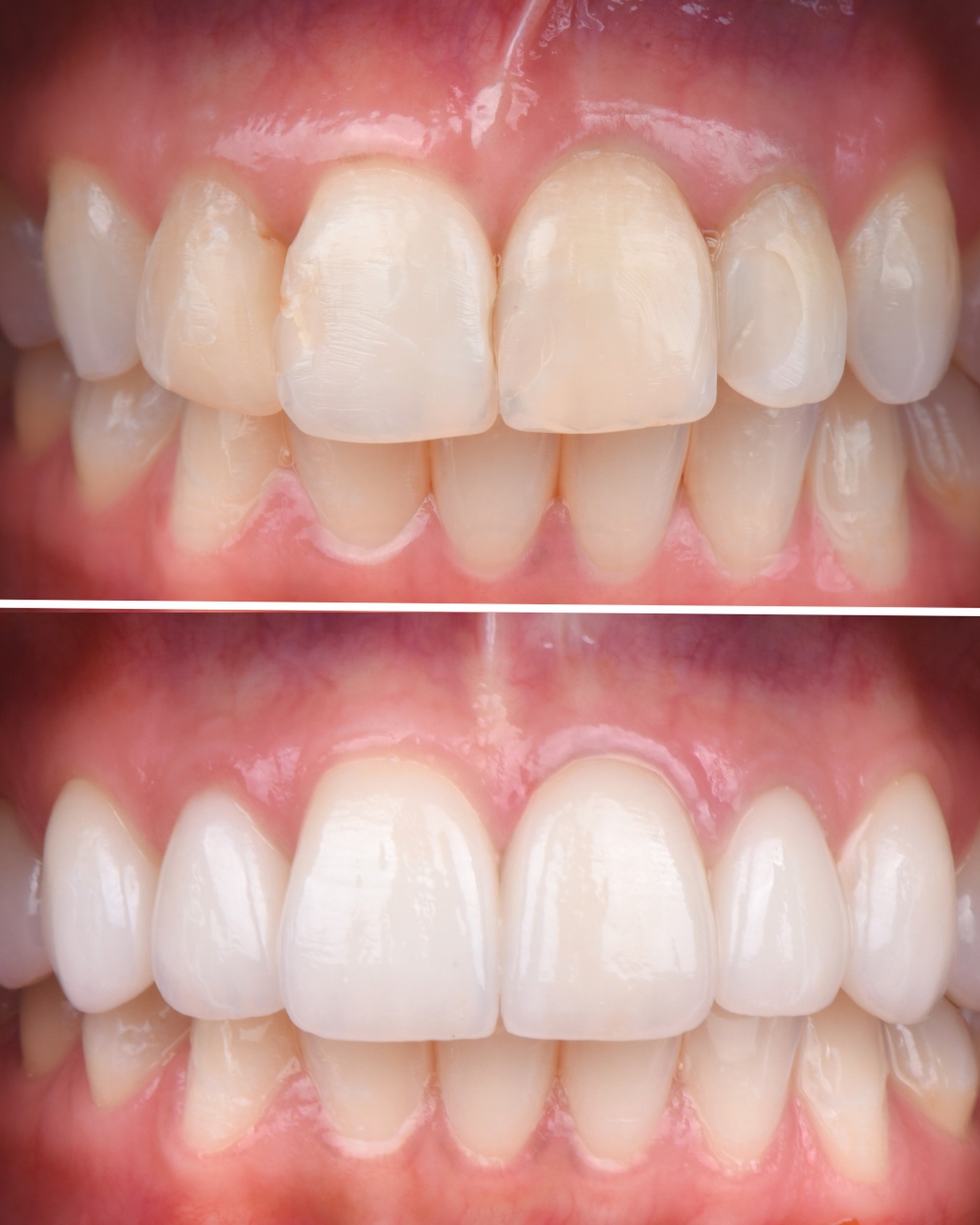 Facetas em cerâmica feldspática para correção de cor e forma.
-
Feldsphatic ceramic veneers for shape and shade correction.
#aestheticdentistry #facetascerâmicas #lentedecontatodental #dentistalisboa #dentistry