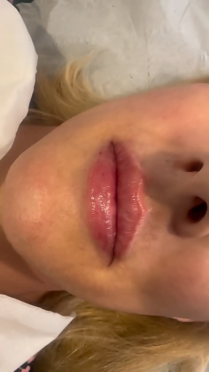Lip fillers remain one of the most popular dermal filler treatments—and for good reason. ✨
There’s nothing quite like the confidence that comes with lips that feel fuller, more defined, and beautifully hydrated.
For this lovely patient, we used just under 1mL of filler to enhance her already gorgeous natural shape. By respecting facial proportions and maintaining a balanced upper-to-lower lip ratio, we achieved a result that looks soft, elegant, and natural.
We also refined the vermilion border (the lip edges) and enhanced the Cupid’s bow to create extra definition and structure.
Subtle enhancements, beautiful results, and lips ready for summer. ☀️💋
#LipFiller #NaturalLipEnhancement #LipHydration #AestheticMedicine #SummerLips