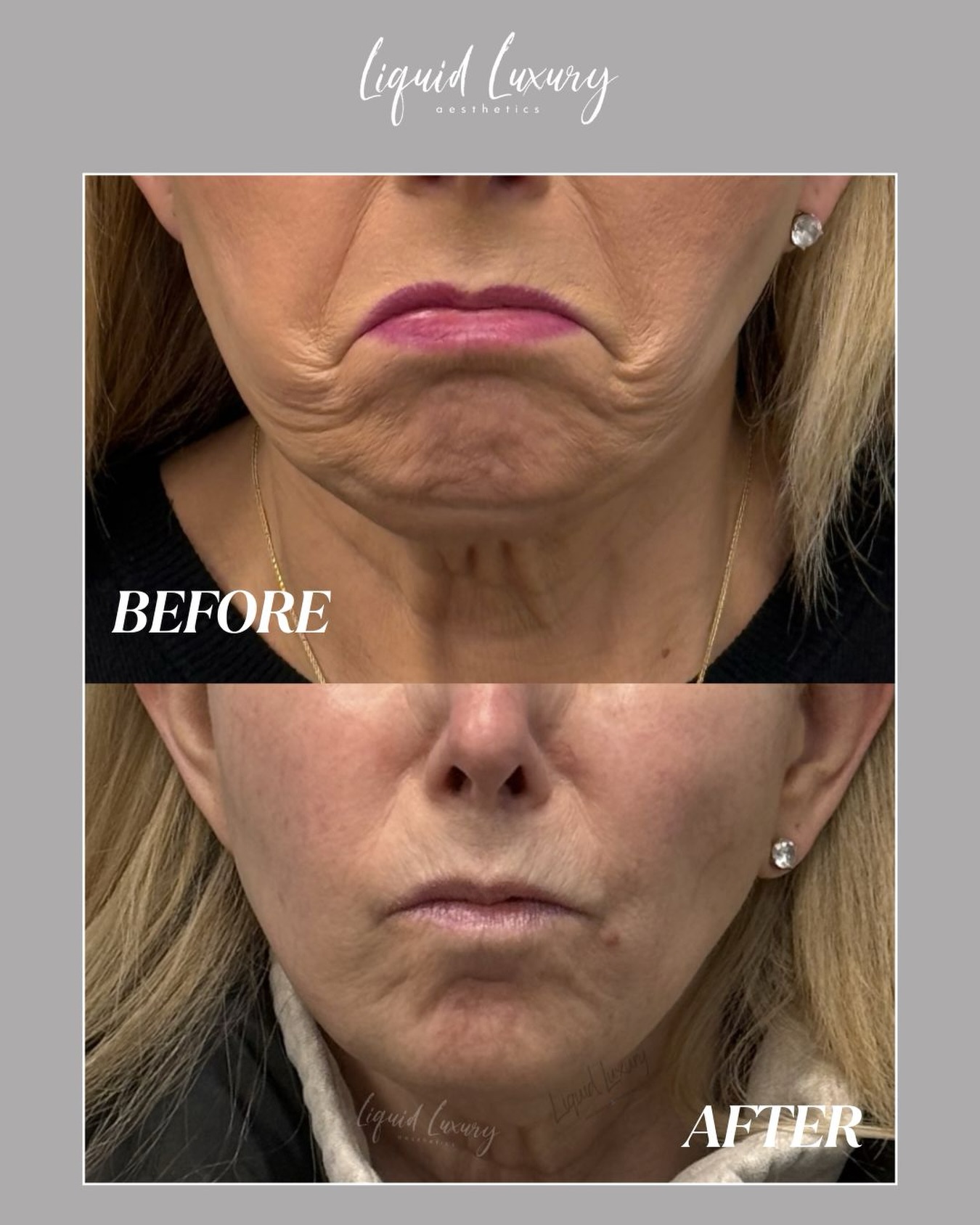 Stopping the downward pull of the lower face with Jeuveau ๐
As we age, certain muscles in the lower face begin pulling downward, which can contribute to heaviness, sagging, and a more tired appearance.
Strategically placed Jeuveau helps relax those muscles, creating a softer, smoother, more lifted look while still keeping your results natural.
Small adjustments can make such a big difference in overall facial balance.
๐ (631)-760-1124
๐ www.liquidluxuryaesthetics.com
๐ 1030 W Jericho Tpke Suite 5 Smithtown, NY 11787
๐ง info@liquidluxuryaesthetics.com
๐ฉ๐ผโโ๏ธ Ina LaRocca-Tocco, FNP-C
๐คณ TikTok: liquidluxury_aesthetics
#Jeuveau #LowerFaceRejuvenation #FacialBalancing #LongIslandMedspa #LongIslandAesthetics