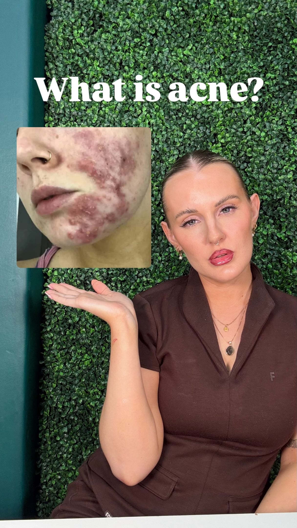 A lot of people hear the word acne and immediately picture severe, painful breakouts 😬
But acne isn’t always cysts and inflamed spots.
Blackheads, whiteheads, those tiny bumps that never seem to go away, recurring chin breakouts - they’re all forms of acne too.
Whether you’re dealing with a few stubborn blackheads or more inflamed, widespread breakouts, understanding what type of acne you’re experiencing is the first step to treating it properly 🙌🏼
If you’re not sure what grade your acne falls into, send me a photo and I’ll happily help you determine what type of acne you’re dealing with and which treatments or support options would be most beneficial 🤍✨