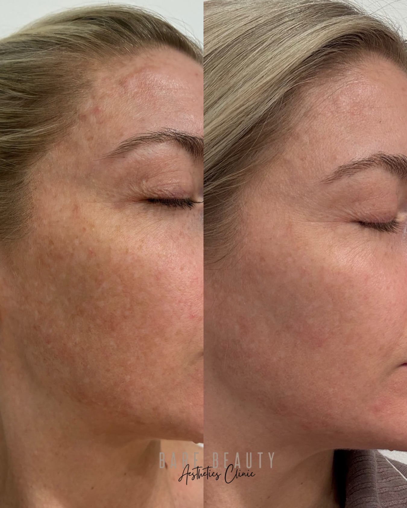Another benefit to Skin Regenerator treatment we offer in clinic.
Melasma is widely considered one of the most challenging forms of pigmentation to treat.
It’s stubborn, complex, and often requires a long-term approach rather than a quick fix.
This result is a great example of what can be achieved with the right treatment plan, combining a course of our skin regenerator with a personalised Aspect DR skincare routine.
Together, they’ve helped improve skin health while dramatically reducing the appearance of stubborn melasma, revealing a brighter, smoother and more even complexion.
Consistency, patience and the right combination of in-clinic treatments and home care can make all the difference.
Individual results vary.
A consultation is required to determine the most appropriate treatment plan.
Images showcased for educational purposes only.
@sunekos_australia @sunekos_official
#bioregenerativemedicine #brisbaneclinic #melasmatreatment #pigment #barebeautybrisbane