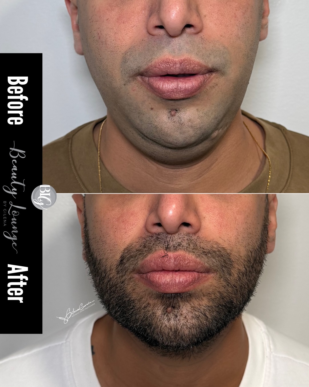⚠️ If you’re still hiding your double chin in photos… this is for you. 👀🔥
Men tend to store more fat under the chin, causing the jawline to lose definition over time. With Levage Endolaser, we can target that stubborn fat, stimulate collagen production, and redefine the jawline with minimal downtime and no surgery.
And yes… these results are REAL. 💪✨
📍 FREE consultation
💳 Cherry payment plans starting at just $99 to help you start your transformation today.
📩 DM us to schedule your appointment before our availability fills up.
⚠️ Si todavía estás escondiendo la papada en las fotos… esto es para ti. 👀🔥
Los hombres suelen acumular grasa debajo del mentón, haciendo que la mandíbula pierda definición. Con Levage Endolaser podemos reducir esa grasa, estimular colágeno y redefinir el contorno facial con una recuperación sencilla y sin cirugía.
Y sí… este resultado es REAL. 💪✨
📍 Evaluación GRATIS
💳 Tenemos Cherry Plans desde solo $99 para que empieces tu transformación hoy.
📩 Escríbenos por DM para agendar tu cita antes de que se llenen los espacios disponibles.
#Endolaser #LevageEndolaser #Jawline #DoubleChin #MensAesthetics