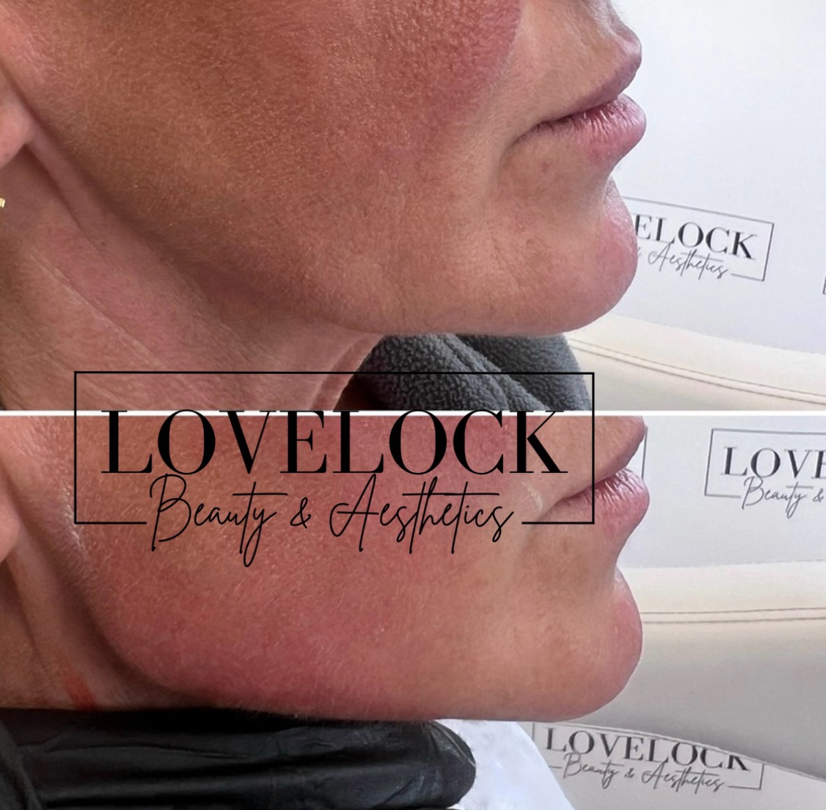 ✨ Jawline goals unlocked ✨
Just look at this incredible before & after! 😍
A little strategically placed jawline filler can make a huge difference by:
💎 Creating a more defined jawline
💎 Enhancing facial structure and balance
💎 Improving side profile definition
💎 Softening the appearance of jowls
💎 Giving a fresher, more sculpted look
The best part? We’re not changing faces, we’re enhancing natural beauty and bringing out the features that are already there. 🙌🏻
National beauty award winner and level 7 expert practitioner
#romsey #warminster #trowbridge #westbury #totton