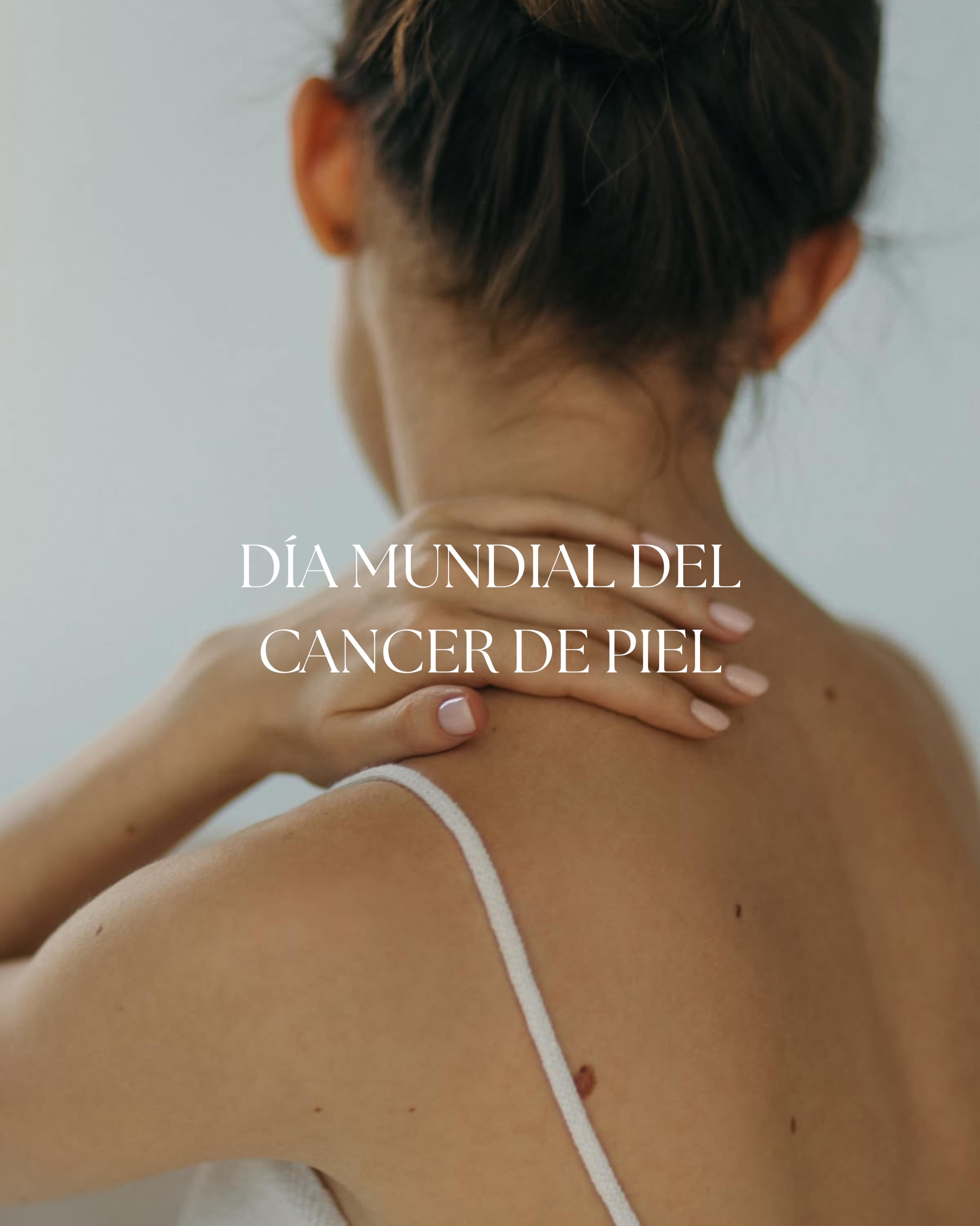 El cáncer de piel es uno de los tumores más frecuentes, pero también uno de los que más se puede prevenir y detectar de forma precoz.
Conocer los factores de riesgo, protegerse adecuadamente del sol y prestar atención a los cambios en la piel son pasos fundamentales.
Un lunar que cambia, una lesión nueva o una herida que no cicatriza merecen una valoración dermatológica.
La detección precoz sigue siendo nuestra mejor herramienta. 🤍
En @estheamedica contamos con tecnología avanzada para la revisión y seguimiento digital de lunares, liderada por @dra.mireiasegui.derma , especialista en diagnóstico y prevención del cáncer de piel.