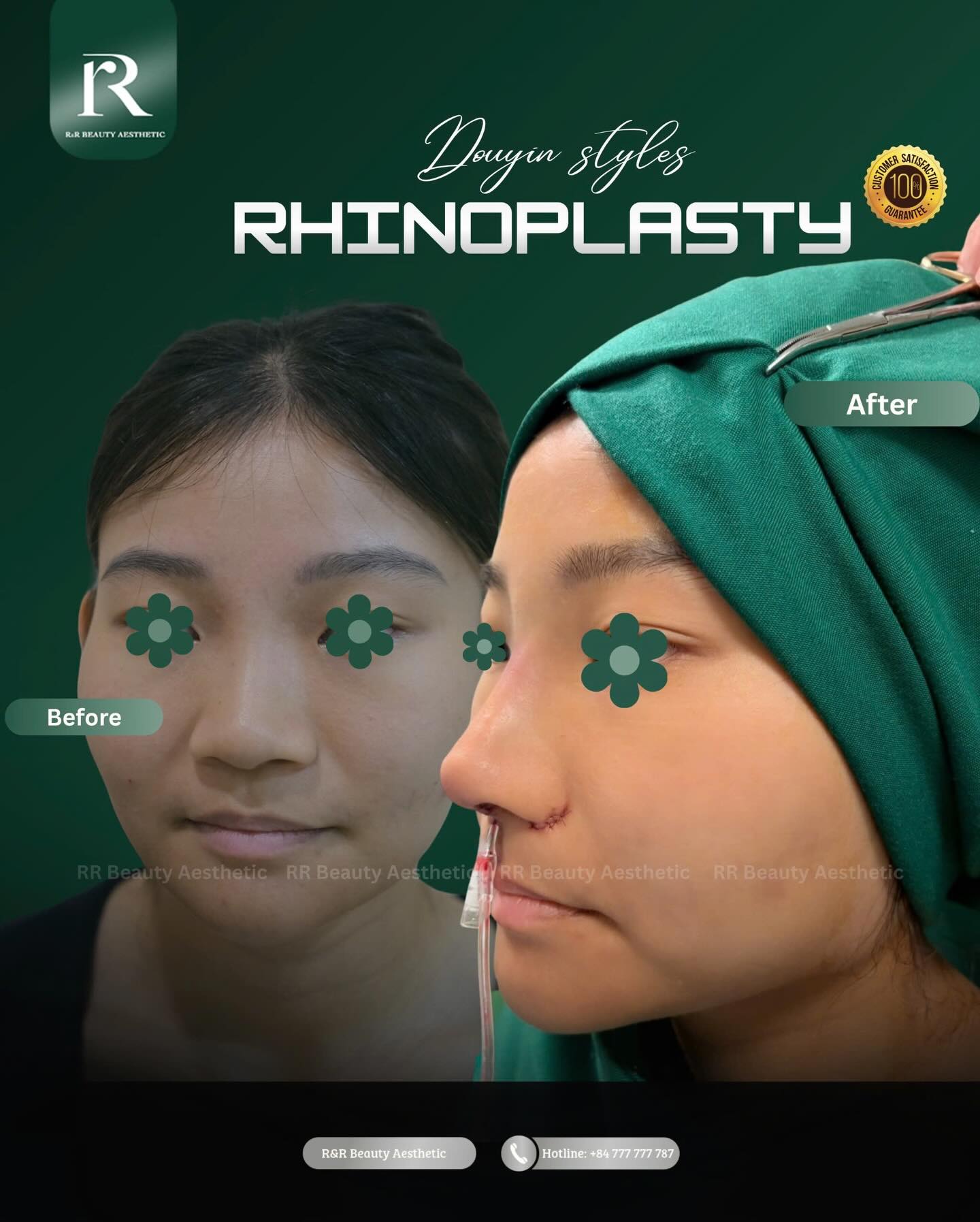 ✨ LOW NOSE BRIDGE CORRECTION
✔ Naturally elevated nose bridge
✔ Softer and more refined facial features
✔ Improved facial balance from every angle
✔ Harmonious nose-to-face proportions
✔ Personalized rhinoplasty design
✔ Dedicated recovery and follow-up care
-------
Vietnam Clinic
R&R Beauty Aesthetic / R&R Beauty Clinic
📍 10A Truc Duong, An Khanh Ward, Ho Chi Minh City, Vietnam
Singapore Studio
R&R Beauty Studio
📍 416 Ang Mo Kio Ave 10, #01-985, Singapore 560416
.
.
#rhinoplasty #rrbeautyaesthetics #aestheticclinic #medicalbeauty facialharmony
low nose bridge correction rhinoplasty facial harmony natural nose enhancement premium aesthetic clinic international beauty surgery profile improvement customized nose design