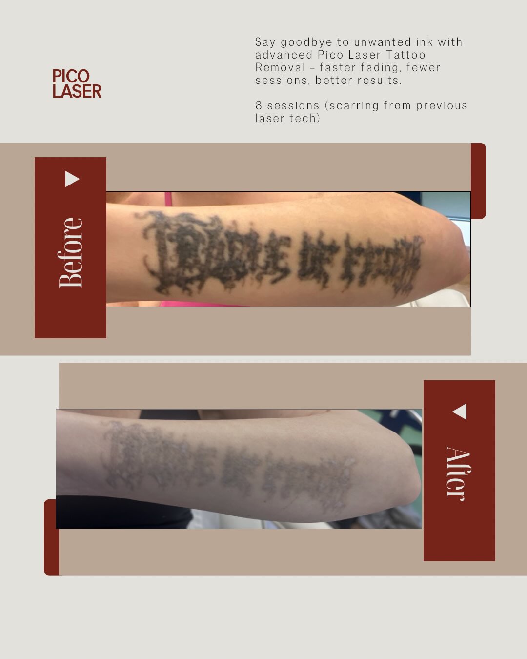 Let’s talk Pico..
Fantastic progress with our Pico Tattoo Removal treatment.
Swipe to see the results ➡️
Using advanced Pico laser technology, we’re able to safely and effectively break down tattoo ink with minimal discomfort and downtime. Whether you’re looking to completely remove a tattoo or fade it for a cover-up, each session brings you closer to clear skin.
• Suitable for a wide range of ink colours
• Effective, targeted treatments
• Minimal downtime
• Bespoke treatment plans tailored to your goals
Tattoo removal is a journey, and results like these are achieved through consistency and the right treatment plan.
If you’re considering tattoo removal, get in touch to arrange a consultation and find out what results may be possible for you.
Please note scarring on this client was from a previous laser specialist - 8 sessions spaced around 7-9 weeks roughly.
R x