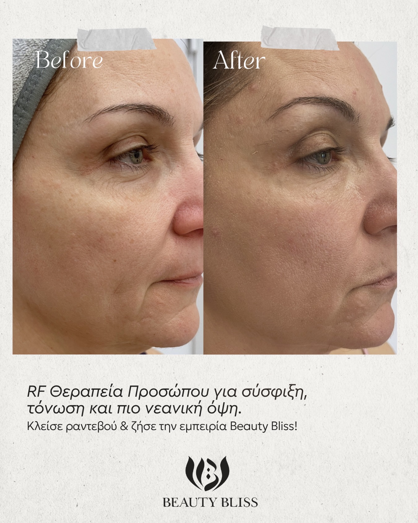 Η επιδερμίδα μας χάνει σταδιακά τη σφριγηλότητα και την ελαστικότητά της, όμως με τη σωστή θεραπεία μπορούμε να ενεργοποιήσουμε ξανά τους φυσικούς μηχανισμούς ανανέωσής της.
Η RF θεραπεία προσώπου διεγείρει την παραγωγή κολλαγόνου και ελαστίνης, συμβάλλοντας στη σύσφιξη, τη λείανση των λεπτών γραμμών και τη συνολική αναζωογόνηση της επιδερμίδας.
✔️ Σύσφιξη και τόνωση
✔️ Βελτίωση της ελαστικότητας
✔️ Πιο ξεκούραστη και νεανική όψη
✔️ Φυσικό αποτέλεσμα χωρίς χρόνο αποθεραπείας
Γιατί η ομορφιά φαίνεται όταν το δέρμα σου είναι υγιές, σφριγηλό και λαμπερό!
🌐www.beautybliss.gr
📍Εθνικής Αντιστάσεως 13, Γέρακας
☎️210 6654005
#beautybliss #beauty #skincare #glowskin