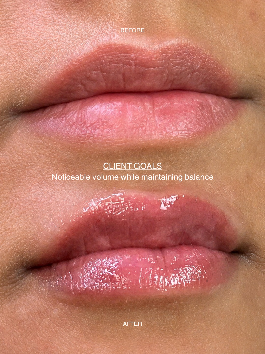 Noticeable volume, customized for her goals 💋 This client came in wanting one thing: more volume.
Not everyone is looking for a subtle enhancement, and that's okay. Her goal was fuller, more noticeable lips while still maintaining balance with her natural features.
By carefully adding volume and improving shape, we were able to create a plumper, more defined look that aligns with her personal aesthetic. The result is enhanced fullness, improved hydration, and lips that make a statement while still complementing her face.
The best lip enhancement results aren't about following trends. They're about understanding each client's vision and creating a treatment plan that helps them achieve it safely and beautifully.
❤️ Whether you love a subtle refresh or a fuller pout, our team can help create a look that's tailored to you.
📍 Kingston, Ontario
📍 Ottawa, Ontario
#KingstonLipFiller #OttawaLipFiller #LipEnhancementOntario #KingstonAesthetics #OttawaMedSpa
