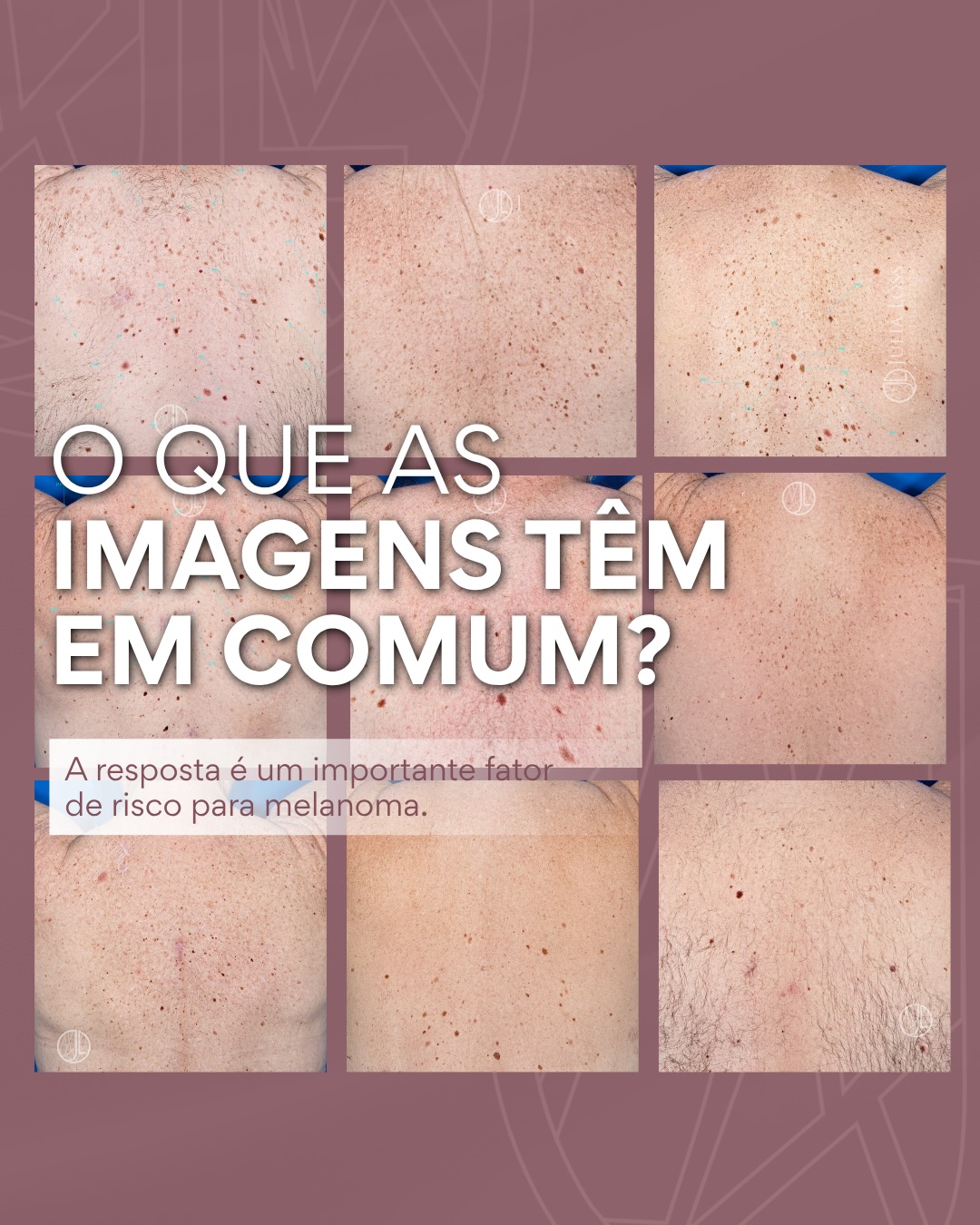 Ter muitas pintas não significa que a pessoa terá melanoma. Mas sabemos que é um dos principais fatores de risco para o desenvolvimento desse tipo de câncer de pele.
O desafio é que, quando existem dezenas ou centenas de lesões, torna-se impossível acompanhar todas apenas pela memória ou por fotografias comuns.
Por isso, pacientes com múltiplas pintas se beneficiam do mapeamento corporal total associado à dermatoscopia digital.
A comparação seriada das imagens permite identificar alterações precoces e selecionar quais lesões realmente precisam de atenção.
O objetivo não é remover todas as pintas!
O objetivo é diagnosticar o melanoma o mais cedo possível.
Dra. Júlia Lóss - Médica Dermatologista Oncológica
CRM 5201085638 RQE 34041
#dermatoscopiadigital #dermatologiaoncologica #fotofinder #nevos #melanoma