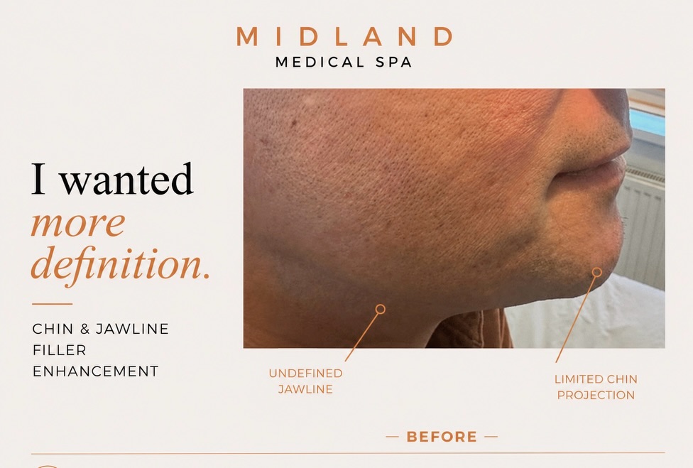 Jawline & Chin Enhancement for Men
A case study demonstrating how just 3–4mL of dermal filler can help create a stronger, more structured lower face.
By carefully enhancing the chin projection and defining the jawline, we can improve facial balance, add sharper contours, and create a more masculine profile — all while keeping the result natural.
Treatment focus:
Chin projection • Jawline structure • Lower-face definition • Masculine contouring
Results vary from person to person. A full consultation is always recommended to assess facial anatomy, suitability, and the safest treatment plan.
#jawlinefiller #chinfiller #mensdermalfiller #jawlineenhancement #profilebalancing