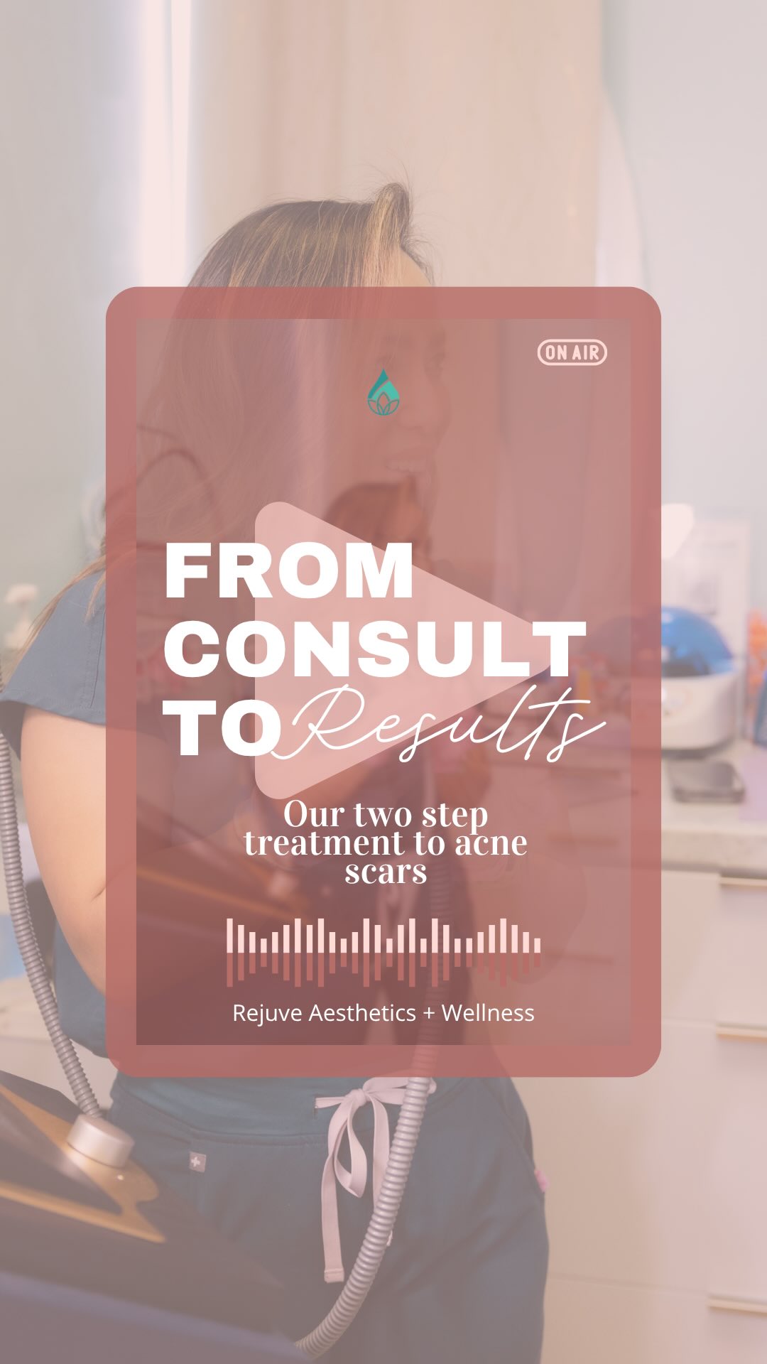 Acne scars go deeper than you think and that’s exactly why surface-level treatments don’t cut it. 🧬
Most acne scars are actually *tethered* down by scar tissue underneath the skin. That’s why no matter how many serums or facials you try, those indentations stick around.
That’s where Subcision + Sylfirm X RF microneedling come in. ✨
Together, they treat both the cause of the scar and the quality of the skin — not just one or the other.
The result? Smoother skin, reduced scars, and a complexion that finally reflects how far you’ve come. 🤍
We recommend at least 3+ sessions for the best results. Ready to start your journey? You know what’s next: Book your consultation with us!
#AcneScars #HonoluluMedSpa #HawaiiMedSpa #AcneScarRemoval