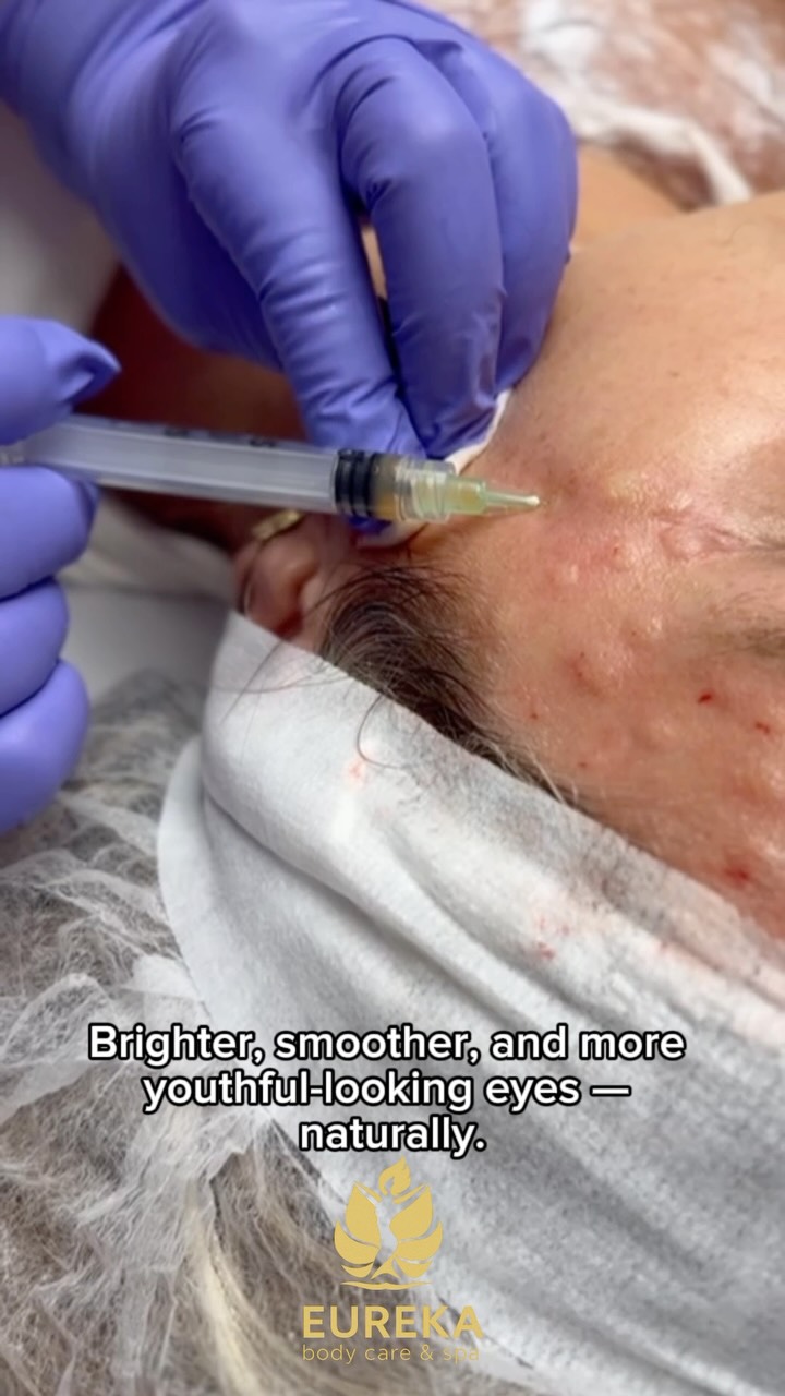 ✨ PRP Under-Eye Rejuvenation ✨
Tired-looking eyes? Dark circles? Crepey skin under the eyes?
PRP (Platelet-Rich Plasma) uses your body’s own natural growth factors to help rejuvenate the delicate under-eye area by stimulating collagen production and improving skin quality.
Benefits of PRP under the eyes:
✔️ Improves skin texture and tone
✔️ Softens fine lines and crepey skin
✔️ Brightens the under-eye area
✔️ Reduces the appearance of dark circles
✔️ Promotes natural collagen production
✔️ Creates a fresher, more rested appearance
Perfect for anyone who wants a natural approach to under-eye rejuvenation without fillers.
📍 37 East 28th Street, Floor 7, Suite #700, New York, NY
📞 (212) 858-0706
📱 Text: (833) 255-9387
#PRPUnderEyes #UnderEyeRejuvenation #NaturalBeauty