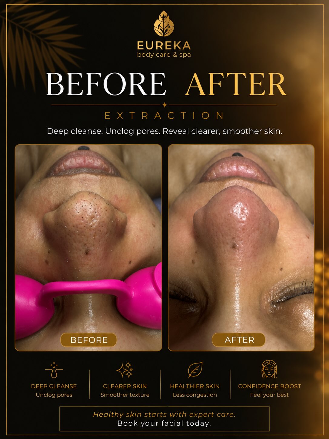 ✨ BEFORE & AFTER EXTRACTION ✨
Healthy skin starts with clean pores.
This transformation shows the difference a professional extraction treatment can make. By removing built-up oil, debris, and congestion from the pores, the skin appears cleaner, smoother, and more refreshed.
✔️ Deep pore cleansing
✔️ Reduced congestion
✔️ Smoother skin texture
✔️ Healthier-looking complexion
✔️ Professional care tailored to your skin
Regular facial treatments and extractions can help maintain clearer skin and improve the overall appearance of enlarged pores and blackheads.
Every skin journey is unique, but healthy skin always starts with proper care.
📍 37 East 28th Street, Floor 7, Suite #700, New York, NY
📞 (212) 858-0706
📱 Text: (833) 255-9387
#FacialNYC #ExtractionFacial #BlackheadRemoval #DeepPoreCleaning