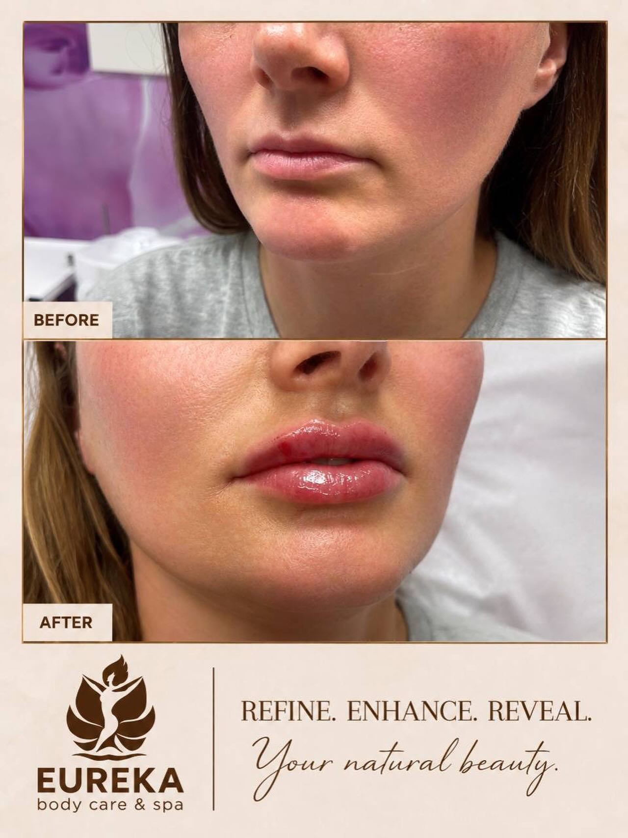 ✨ Naturally enhanced. Beautifully you.
Subtle volume, balanced proportions, and soft, natural-looking lips that complement your unique features—not change them.
Because the best results are the ones that look effortless. 💋
📍 Eureka Body Care & Spa
📞 (212) 858-0706
💬 Text: (833) 255-9387
#LipFiller #NaturalLips #LipEnhancement #BeforeAndAfter #AestheticMedicine BeautyResults EurekaBodyCare NYCMedSpa NaturalBeauty LipGoals