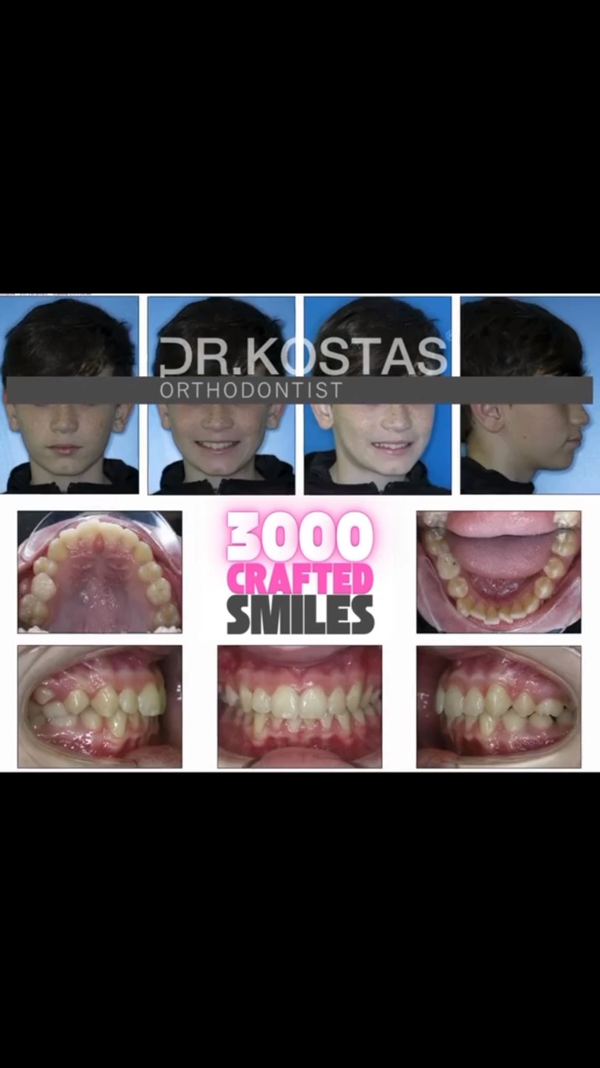 More than 3,000 beautiful smiles crafted in Dublin City by Dr. Kostas and still going strong 😃 🔥 #newssmile #smiledesign #drkostas #bracesdublin #orthodontist